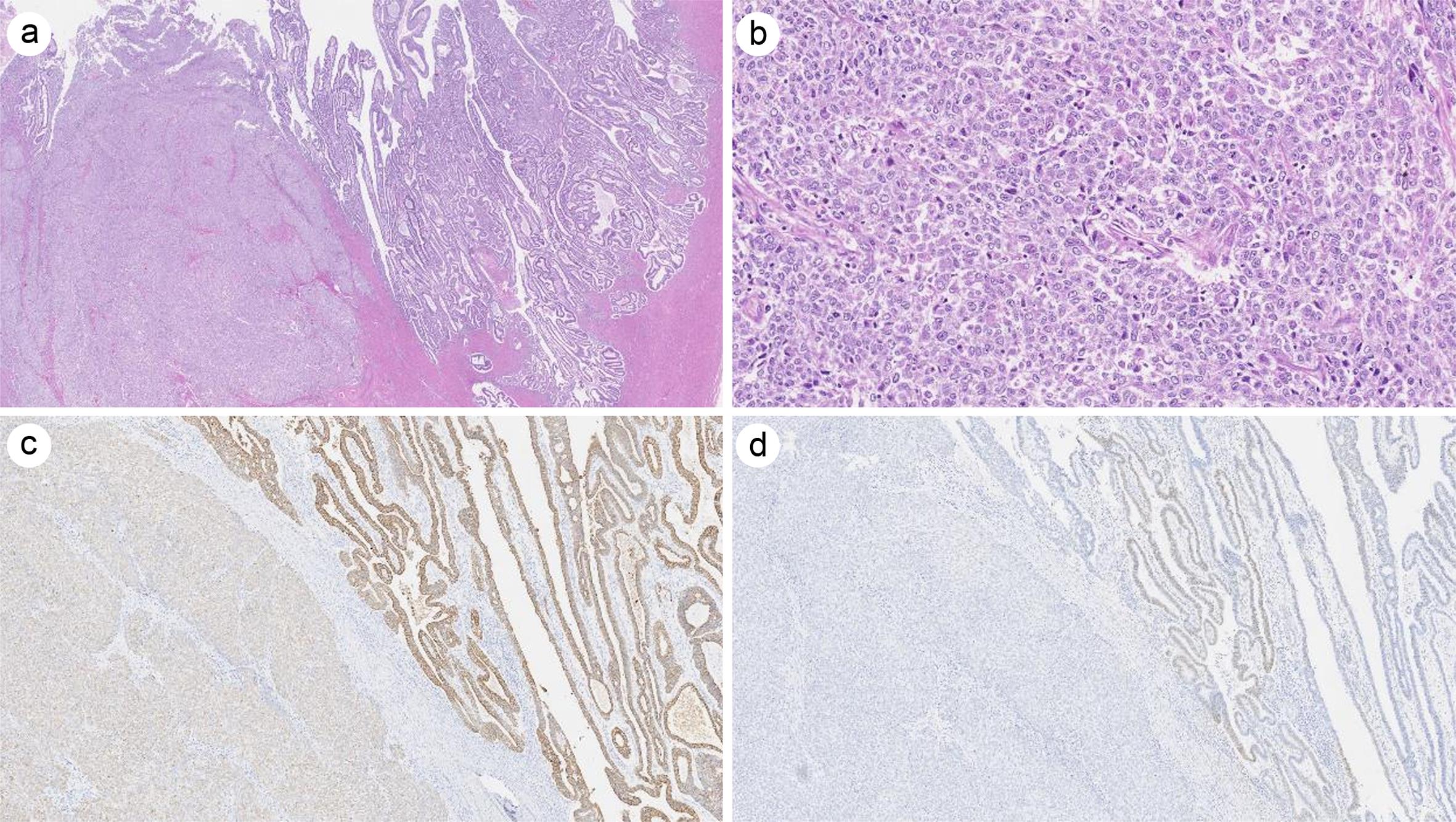Dedifferentiated endometrial carcinoma.