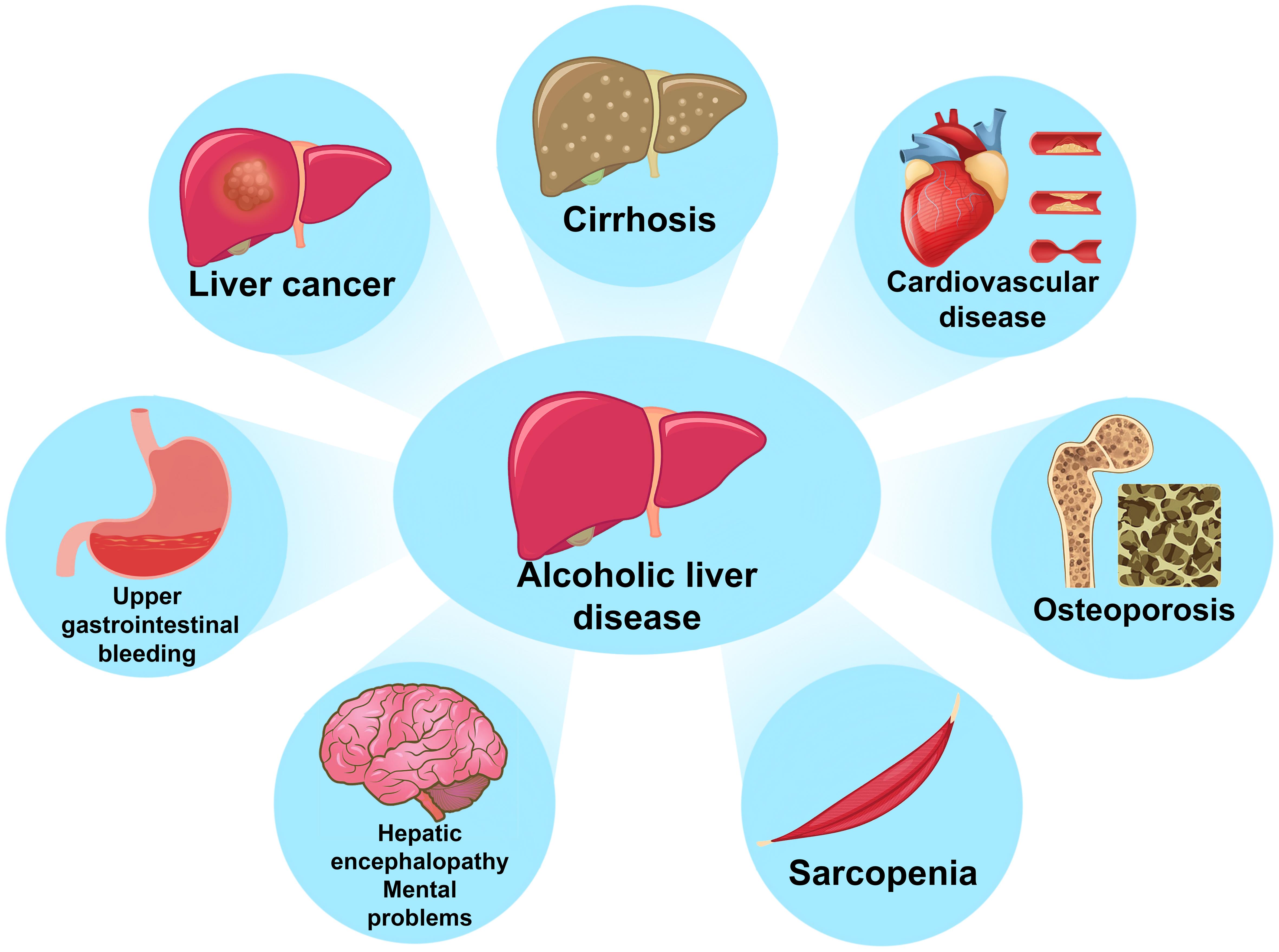 Complications associated with alcoholic liver disease.