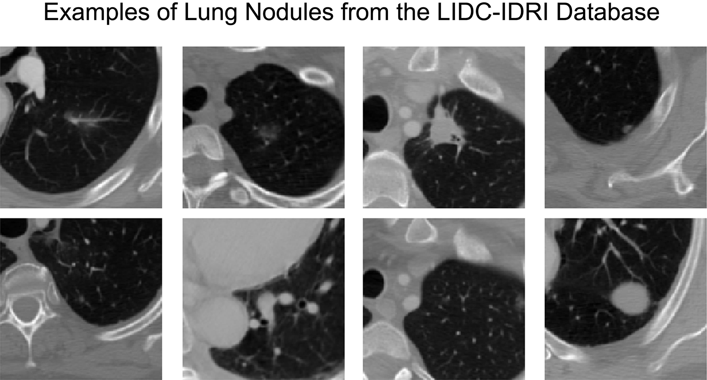 Examples of lung nodules from the database (LIDC-IDRI) used in the learning and testing phases of this study, with their varied characteristics.