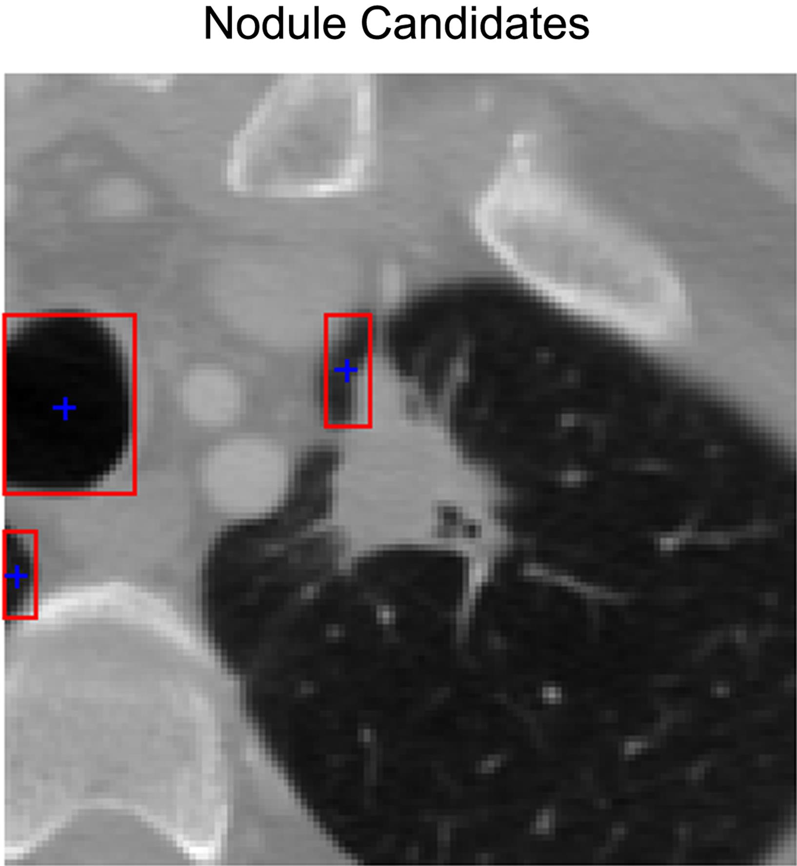Illustration of the nodule candidate automatically detected by the proposed algorithm classification results.