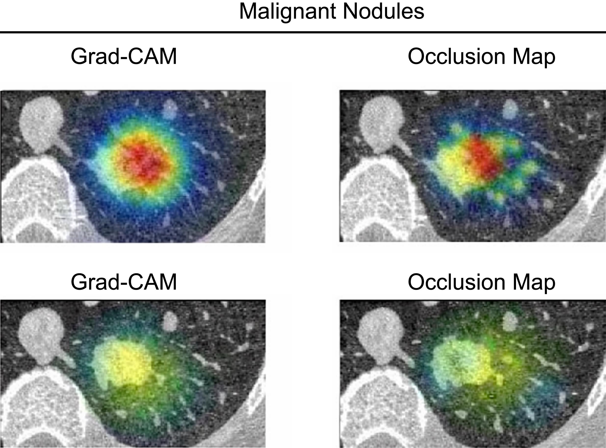 Visual explanation of model decisions for malignant and benign pulmonary nodules using Grad-CAM and occlusion sensitivity.