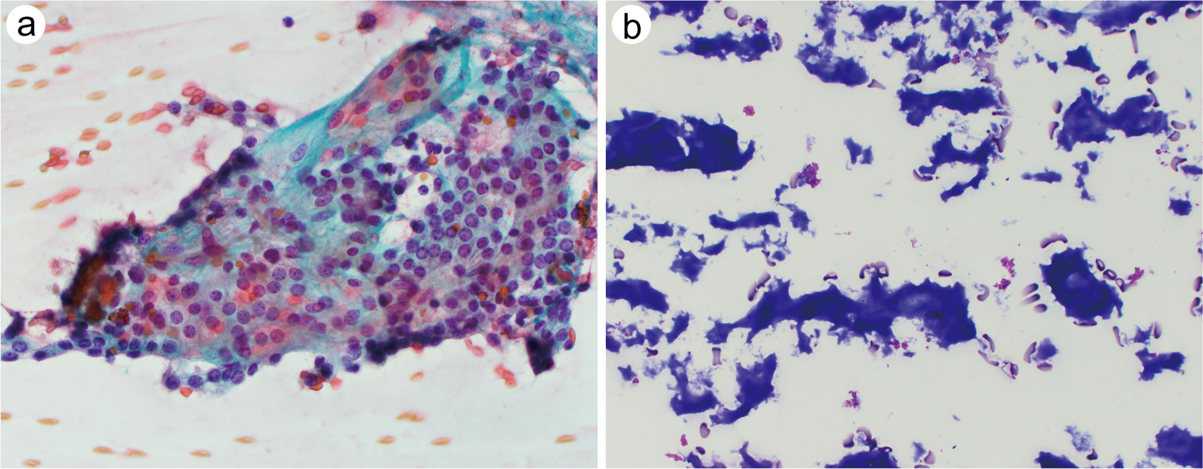 Benign (consistent with follicular nodular disease).