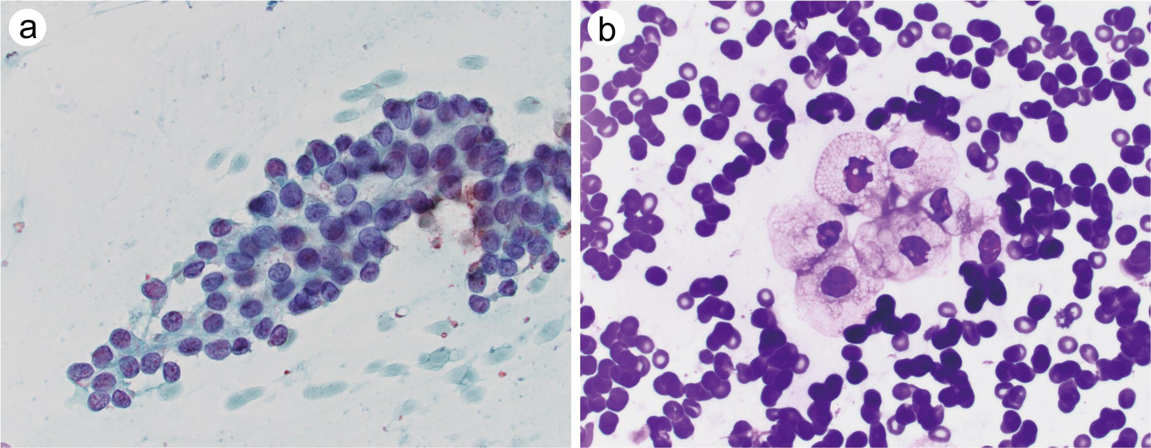 Atypia of undetermined significance (AUS)-nuclear atypia.