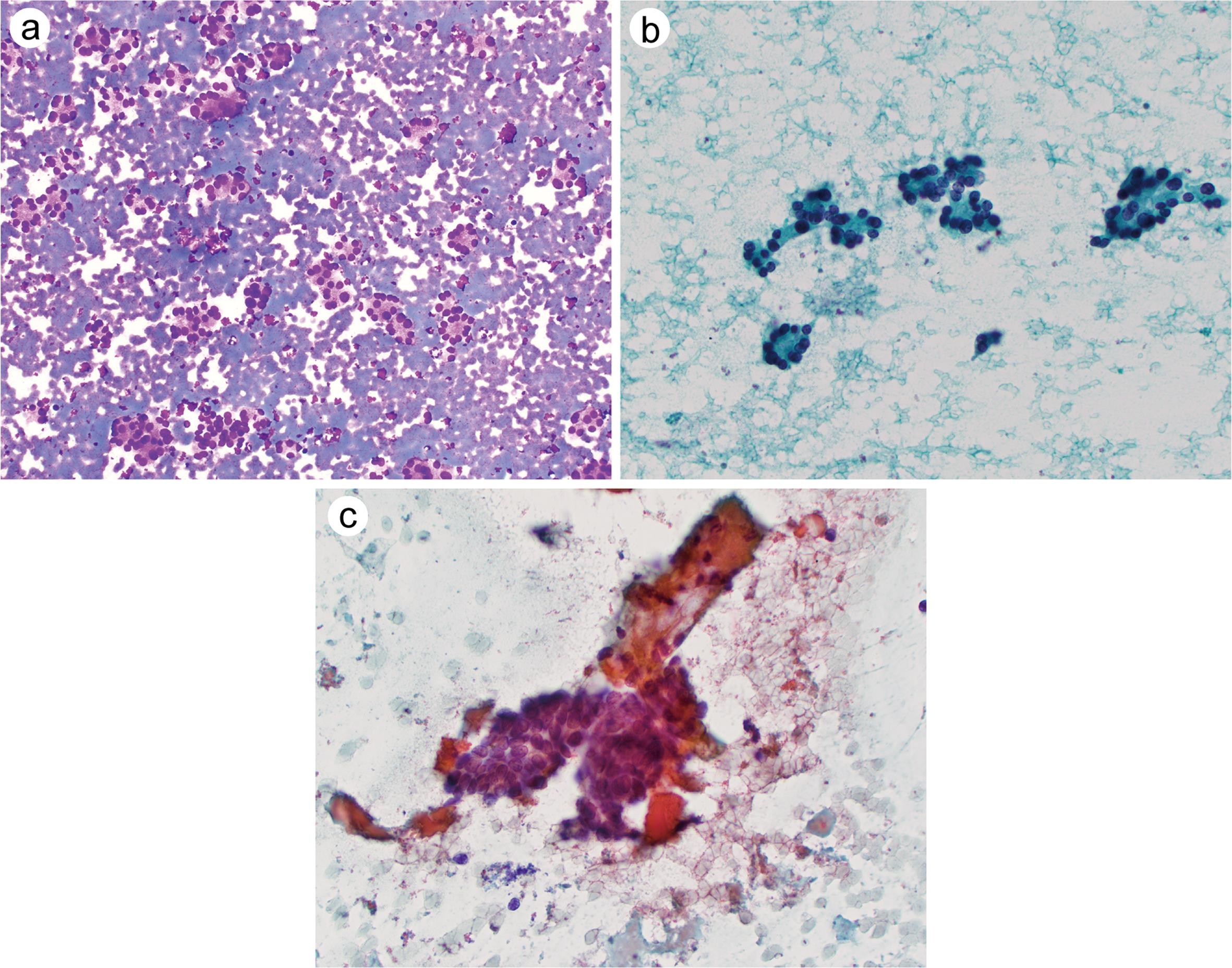 Follicular neoplasm.