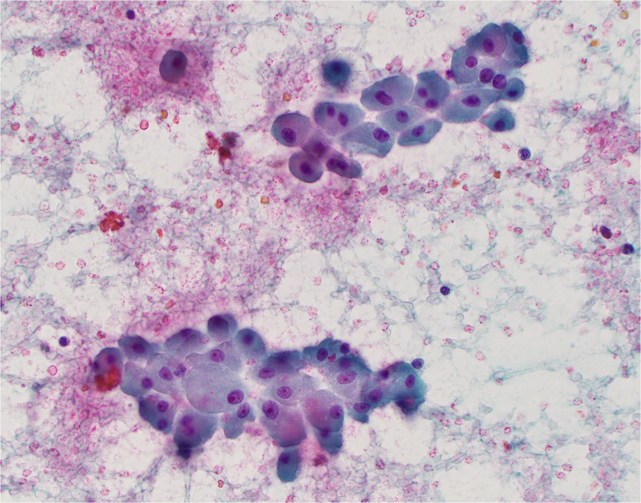 Oncocytic follicular neoplasm.