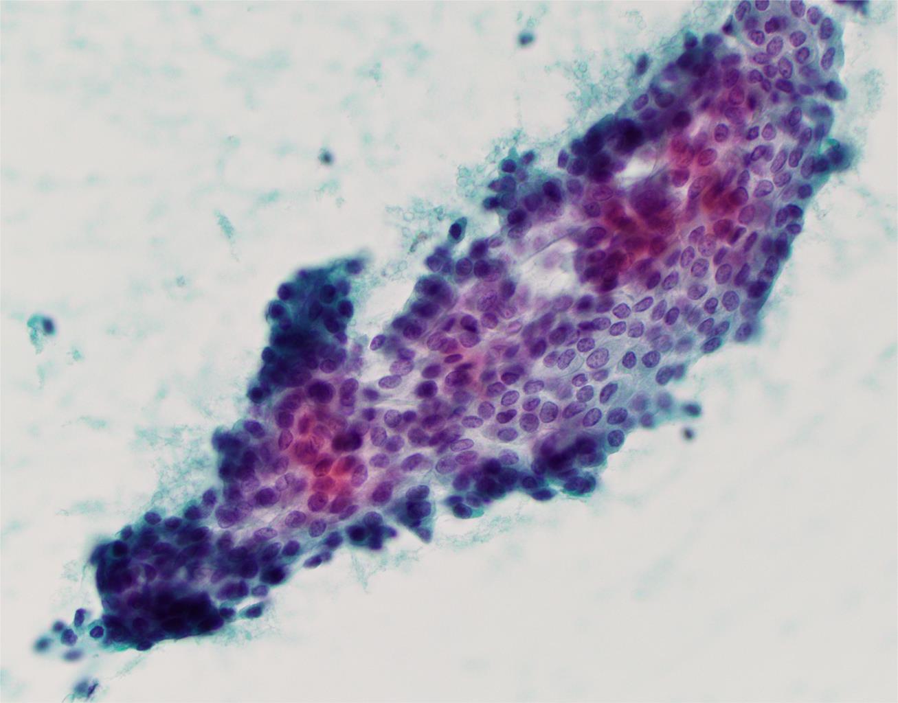 Suspicious for papillary thyroid carcinoma.