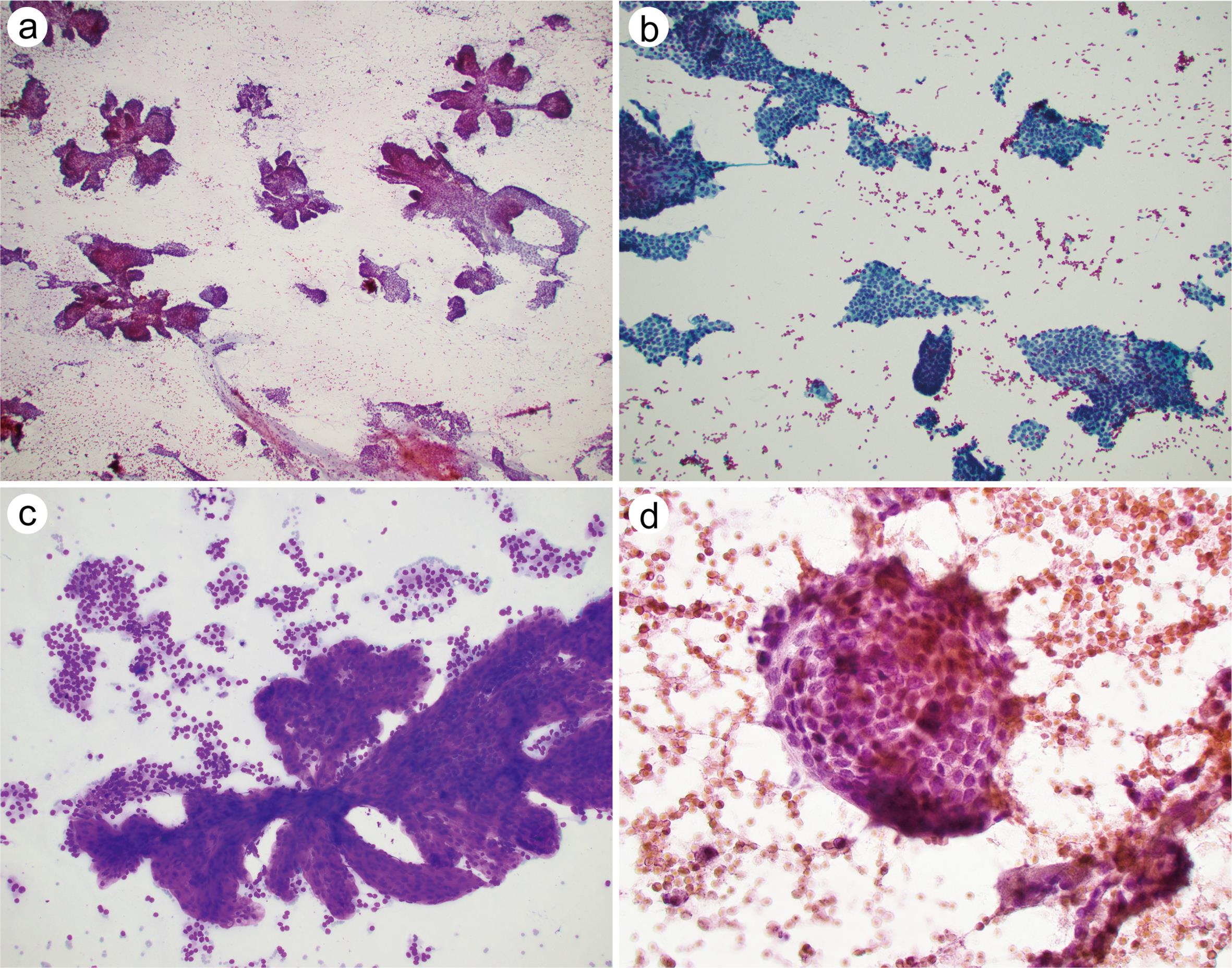 Architectural pattern of papillary thyroid carcinoma (PTC).