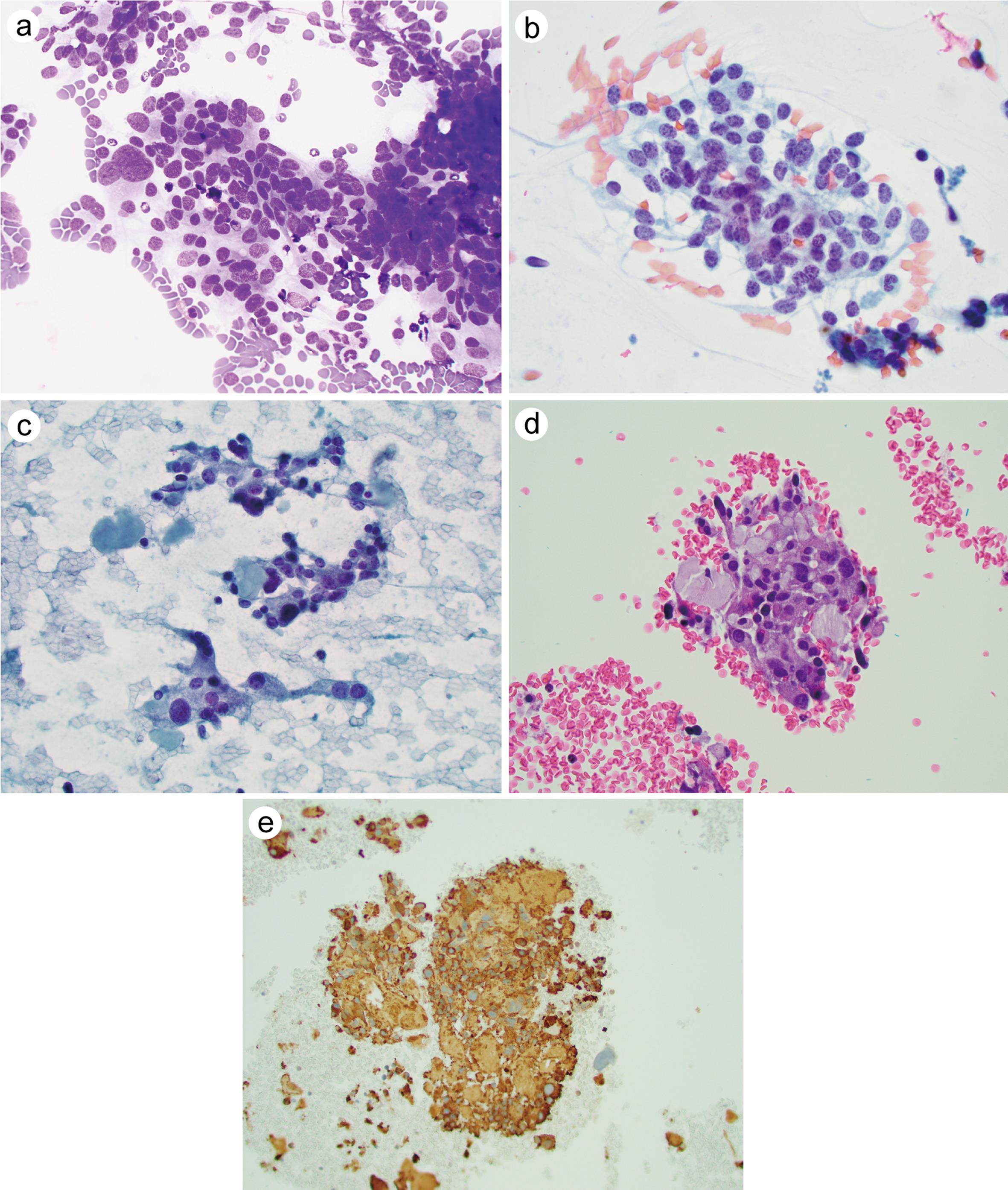 Medullary thyroid carcinoma (MTC).