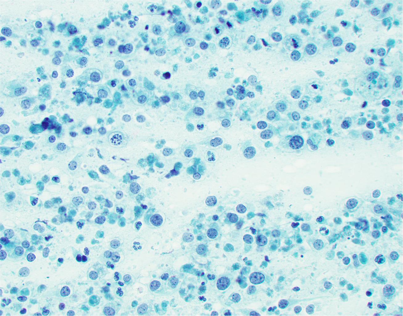 Poorly differentiated carcinoma characterized by uniform tumor cells with small, convoluted nuclei and a high nuclear-to-cytoplasmic ratio.