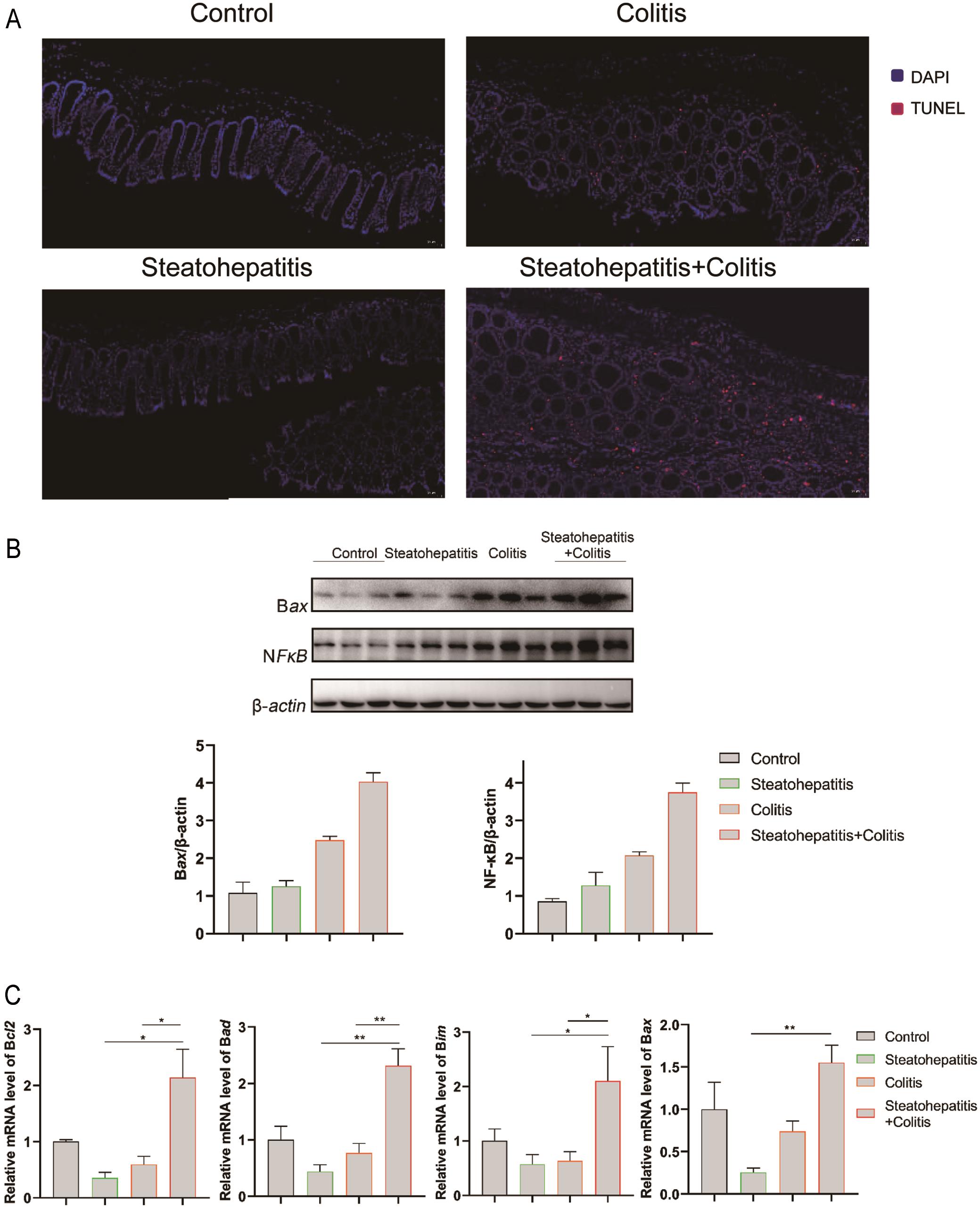 Premorbid NASH disturbed colon inflammatory and apoptotic pathways in UC.