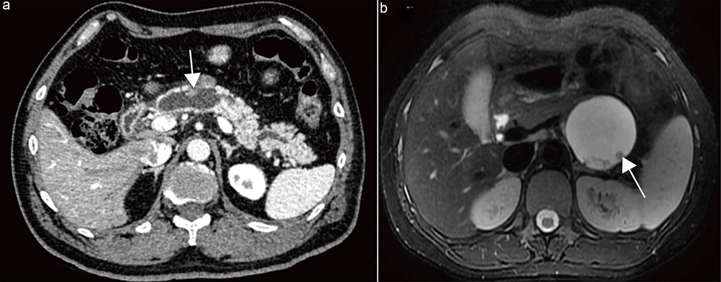 Measurement of mural nodules.