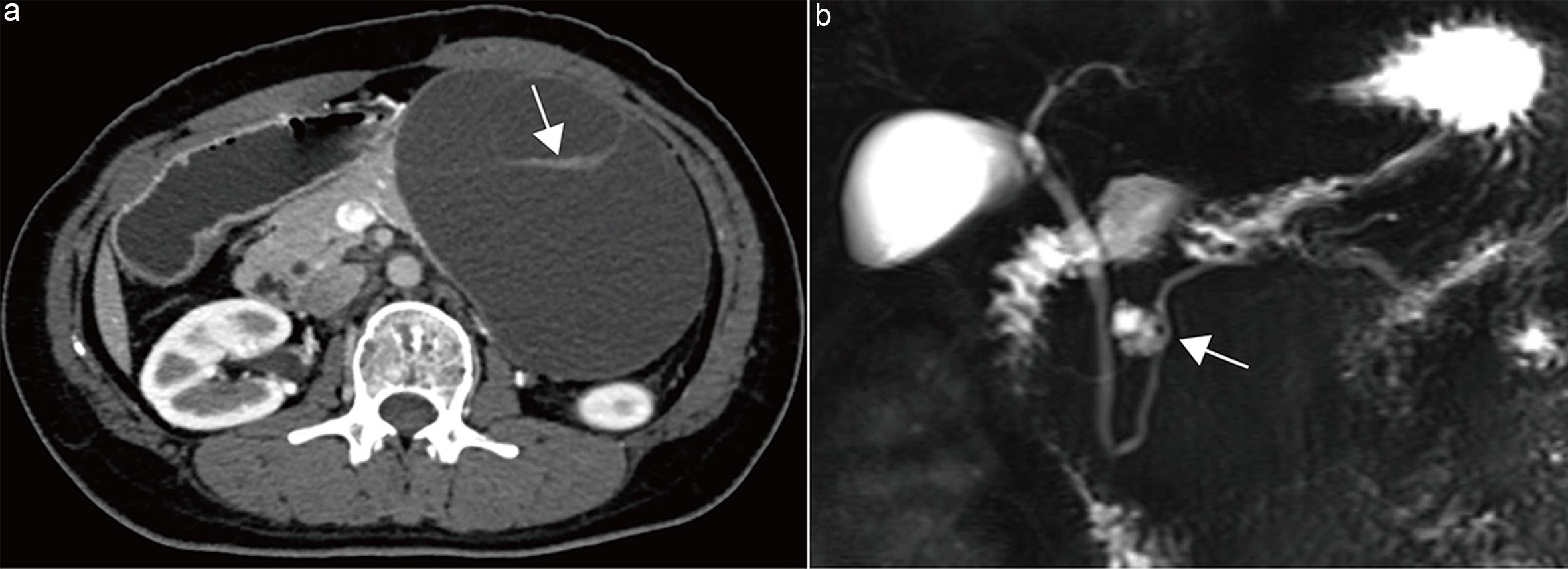 Assessment of cyst wall/septal thickening and communication with the main pancreatic duct.
