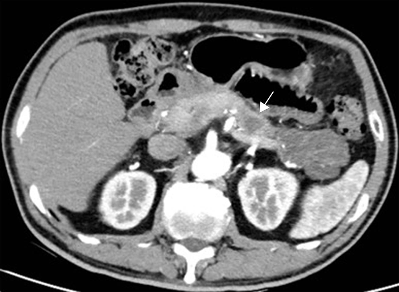 Main-duct intraductal papillary mucinous neoplasm (MD-IPMN).