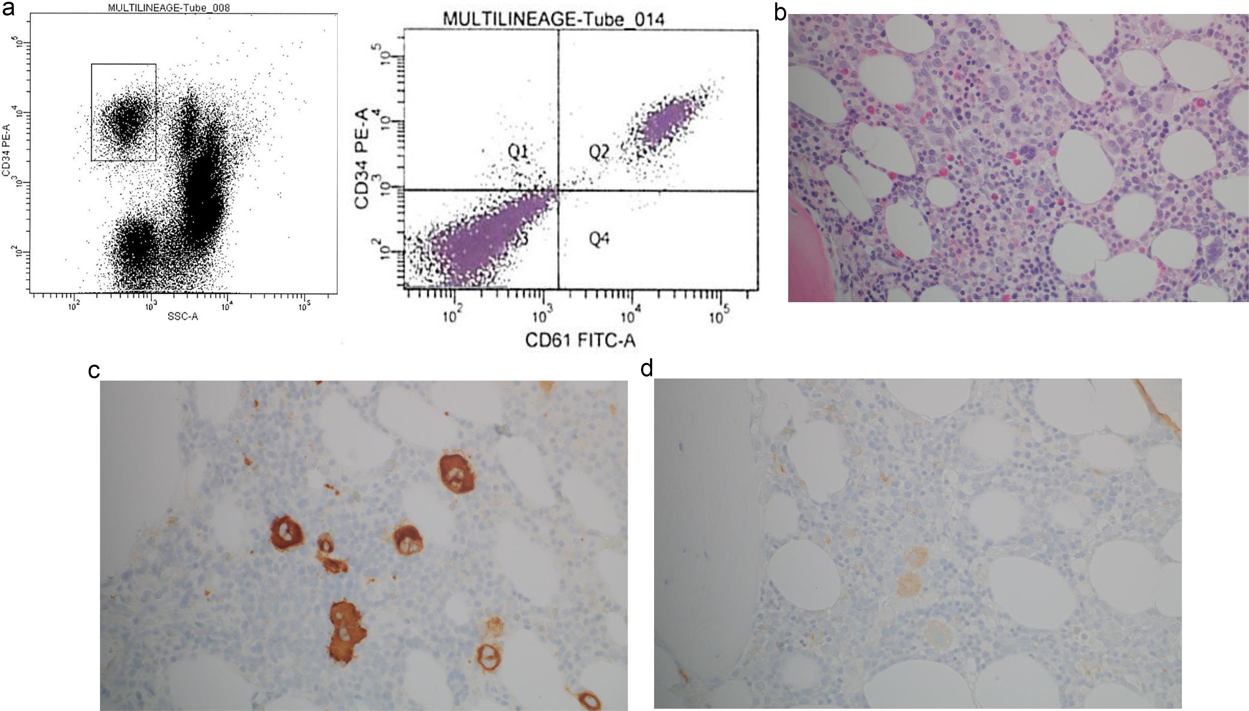 Flow cytometry analysis of peripheral blood (a) in 2015 showed that CD34<sup>+</sup> cells were only positive for CD61. Bone marrow biopsy showed dysplastic megakaryocytes (b), which were highlighted by CD61 (c). Some megakaryocytes were also positive for CD34 (d). (b: H&E, 400×; c and d: Immunostaining, 400×).