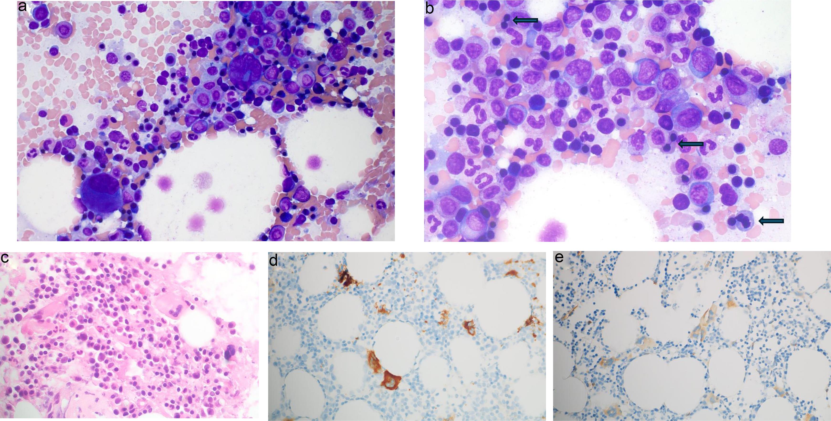 Bone marrow findings in 2020.