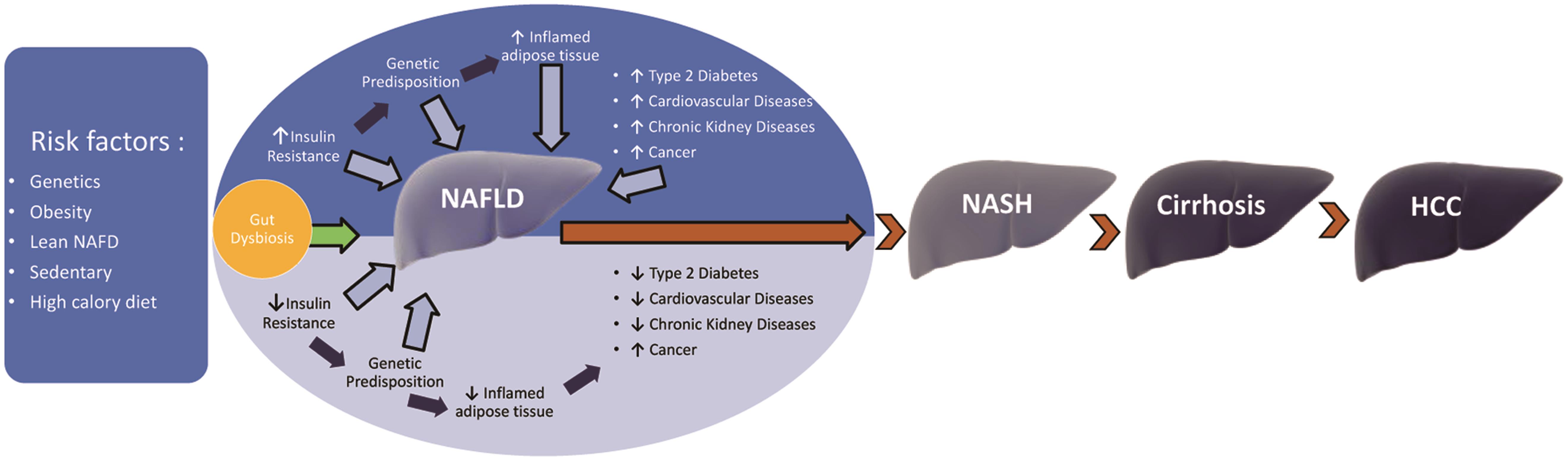 Schematic representation of the pathogenesis of NAFLD and progression from NAFLD to NASH, cirrhosis, and HCC.