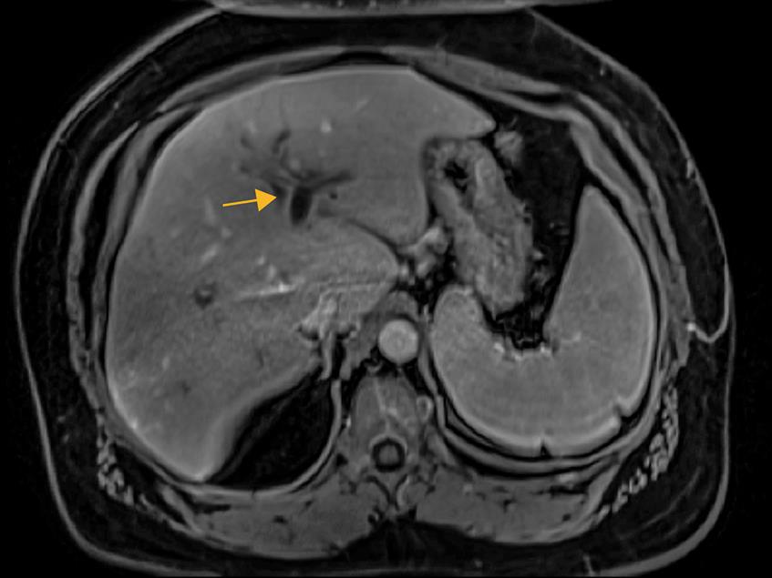 Contrast-enhanced T1-weighted MRI.