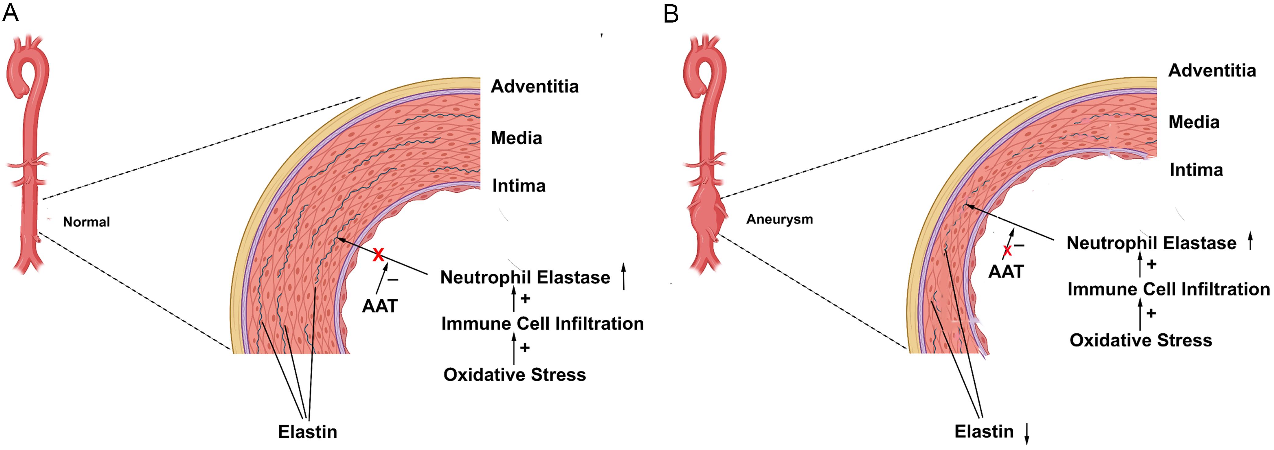 Proposed mechanism of aneurysms associated with AATD.
