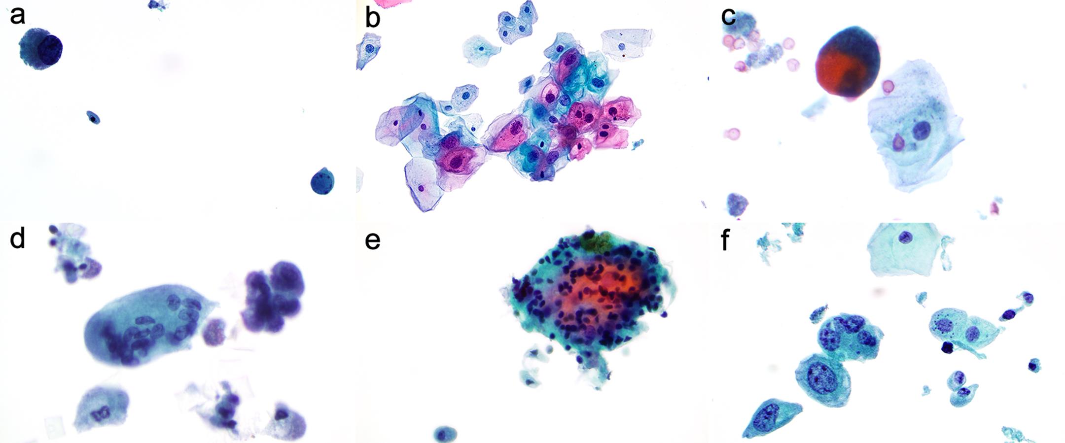 Virus cytopathic effects. Polyoma virus-infected epithelial cells present with a large, ground-glass-like intranuclear viral inclusion (a). HPV-infected squamous cells present with hyperchromatic nuclei, with irregular nuclear membranes and perinuclear halos (b). Radiation effects: Affected cells present with cytomegaly, nucleomegaly, multinucleation, nuclear vacuoles, cytoplasmic polychromasia, and preserved nuclear/cytoplasmic (N/C) ratios (c). Bacillus Calmette-Guerin (BCG) effects: Reactive urothelial cells, multinucleated giant cells (d), and granuloma (e). Chemotherapy effects: the mitomycin and thiotepa caused the nuclear enlargement, multinucleation, and hyperchromasia of superficial cells (f).