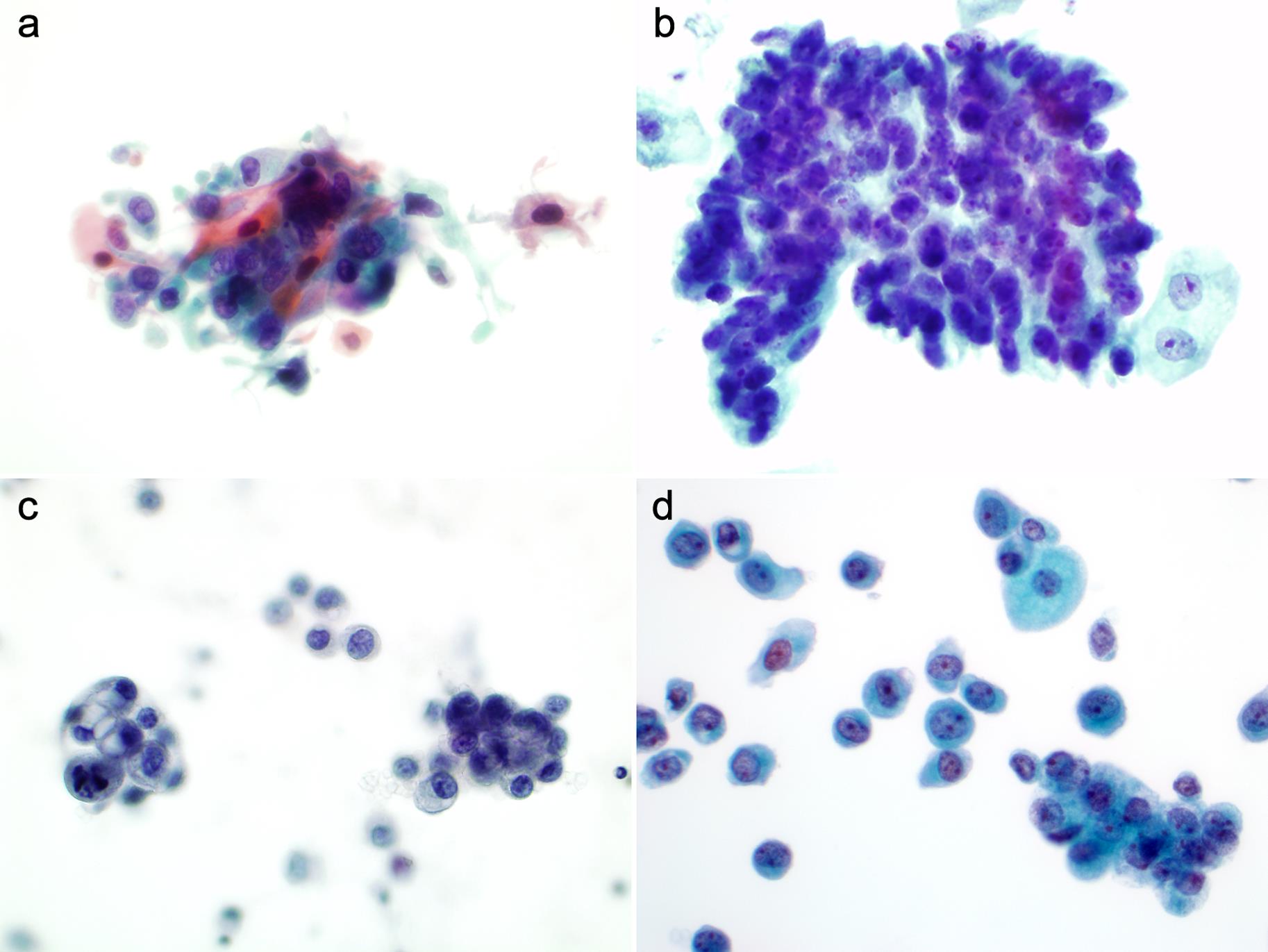 Variants of high-grade urothelial carcinomav (HGUC). HGUC may present with squamous differentiation (a), glandular differentiation (b), micropapillary HGUC features (c), and plasmacytoid HGUC features (d).