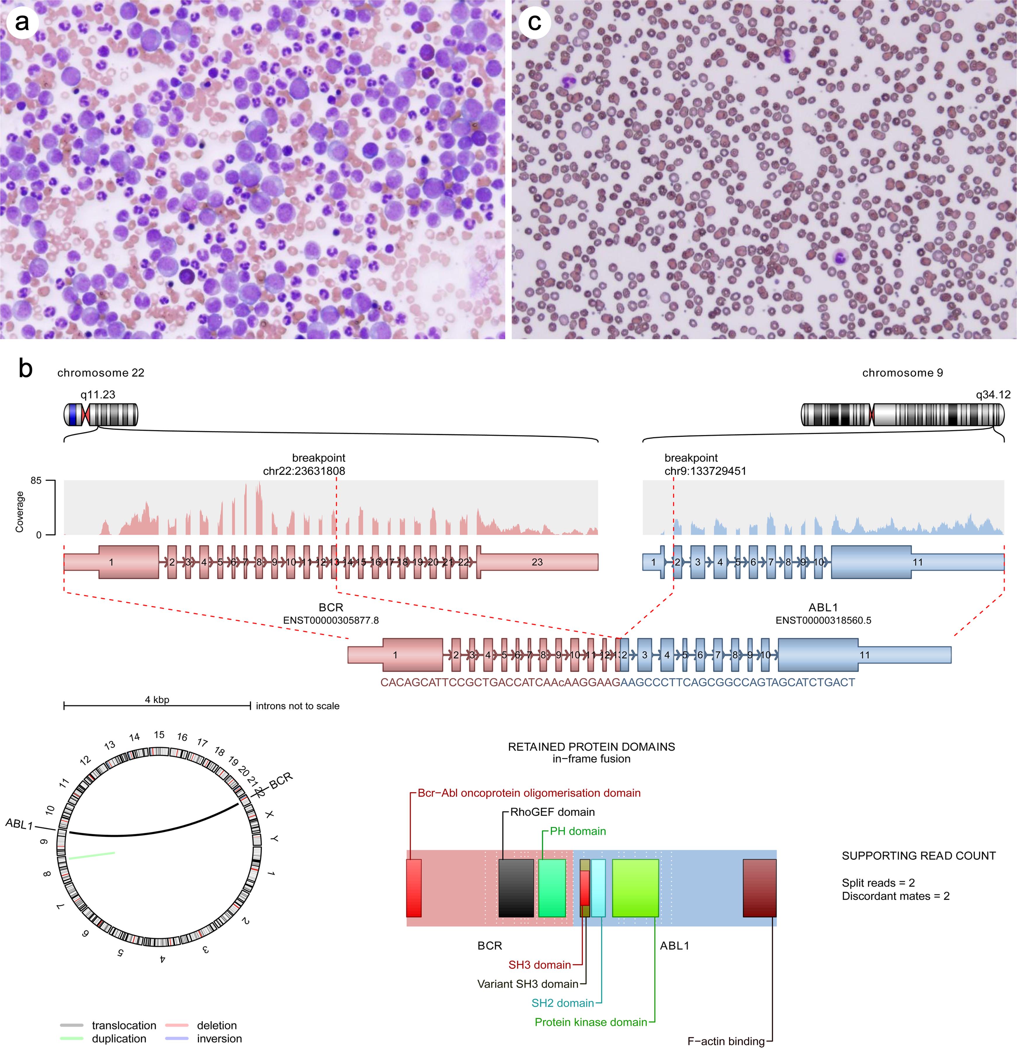 Chronic myeloid leukemia, Chronic phase and Philadelphia chromosome (BCR::ABL1 fusion gene).