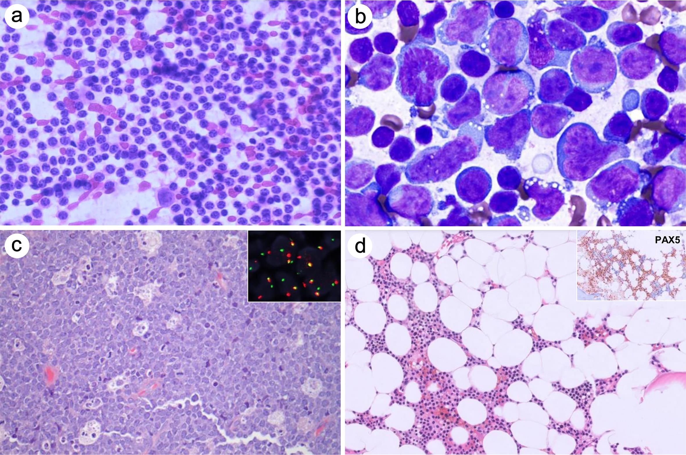 B-cell lymphoma.