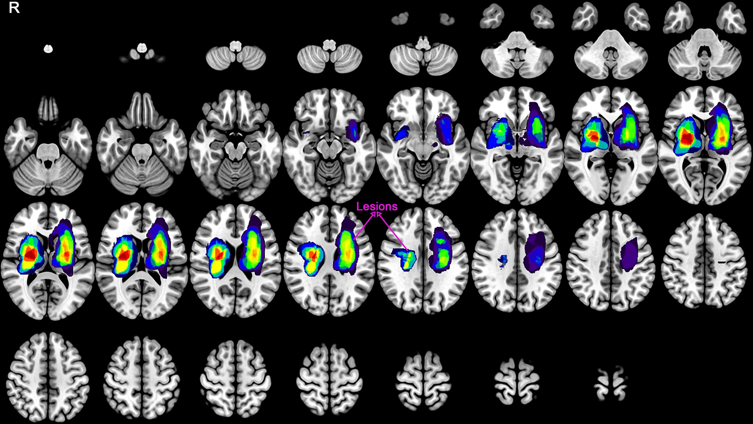 The frequency overlap map of ICH lesions.