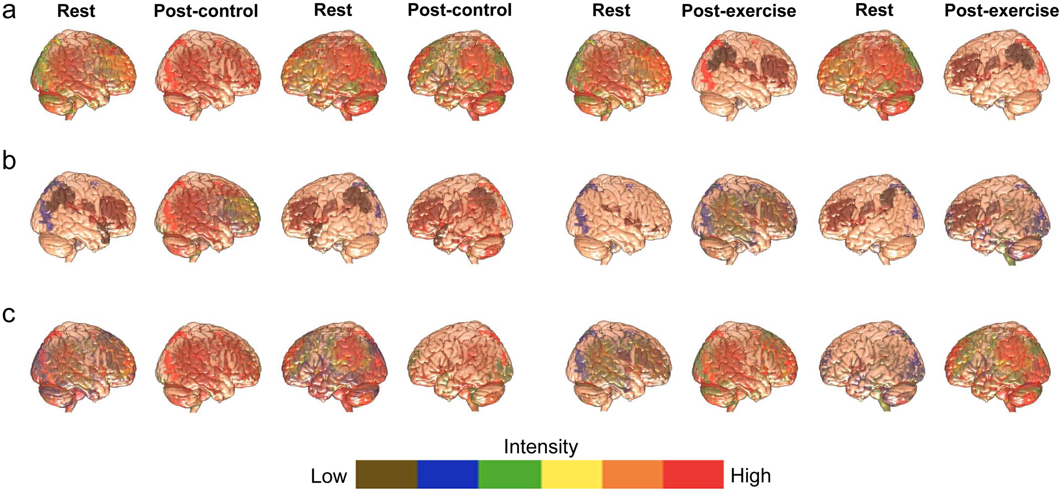 Neuroimages depicting right- and left-brain hemispheres of each patient during rest, control, and exercise conditions.