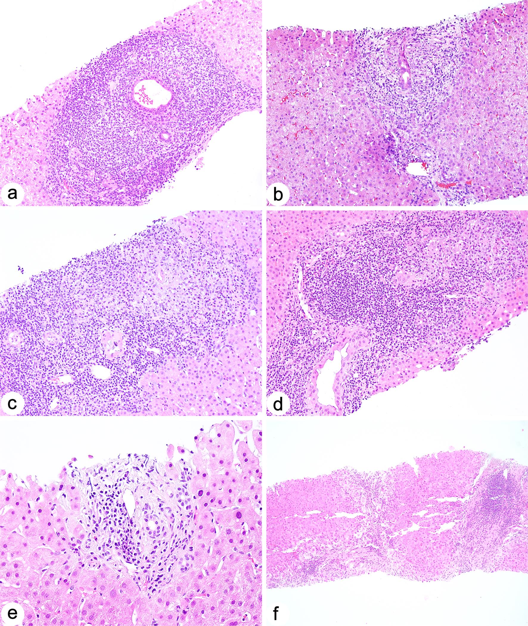 Recurrent primary biliary cholangitis in liver allograft core biopsies.