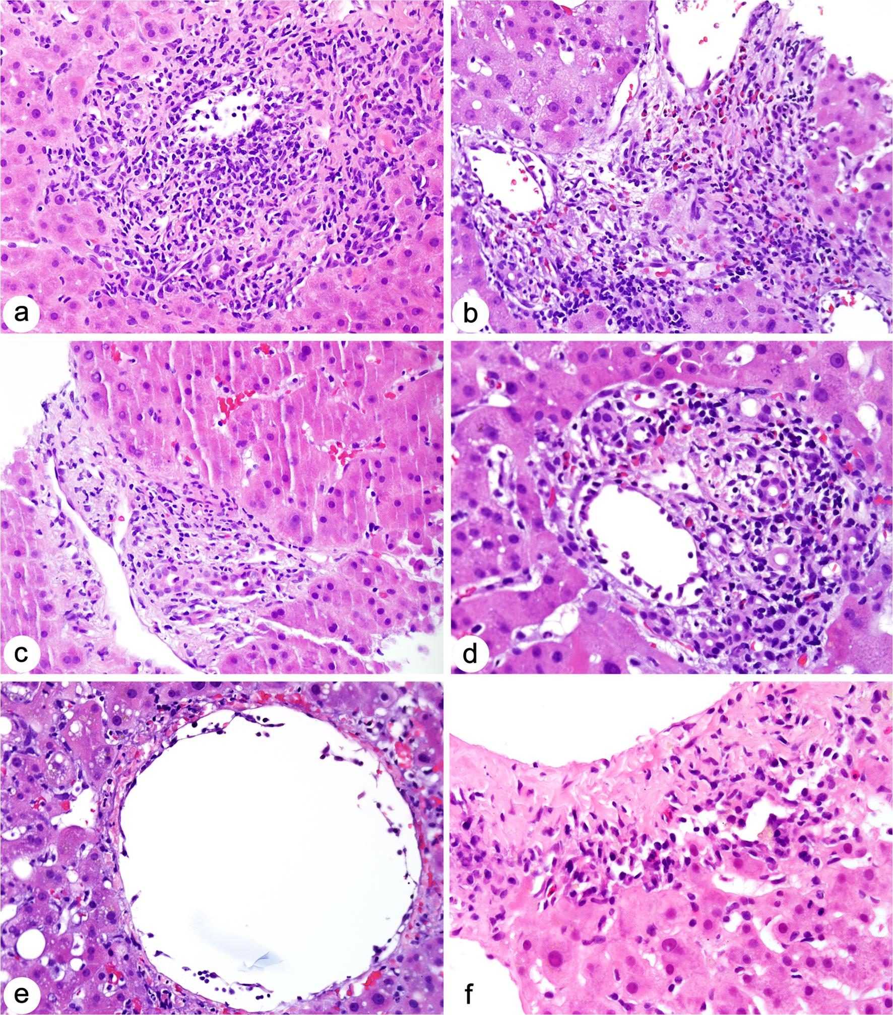 T cell-mediated rejection in liver allograft.
