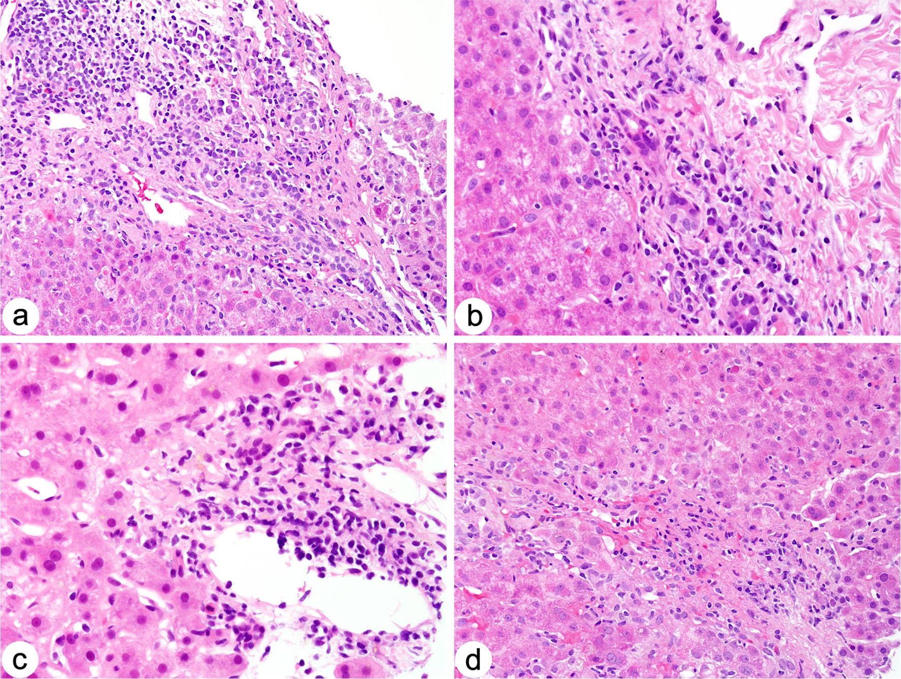Plasma cell-rich rejection in liver allograft biopsies.