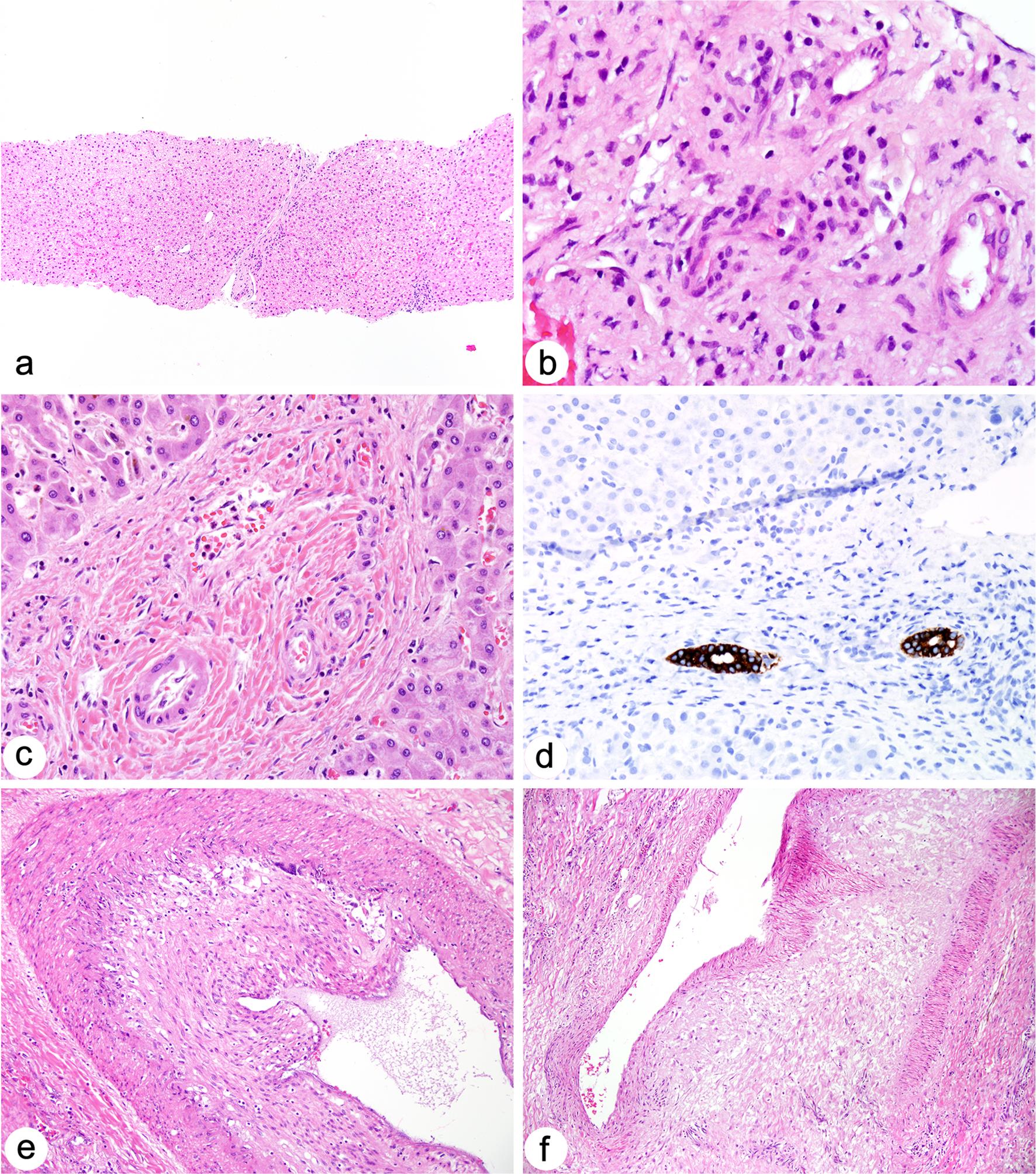 Chronic rejection in liver allograft biopsies and resections.