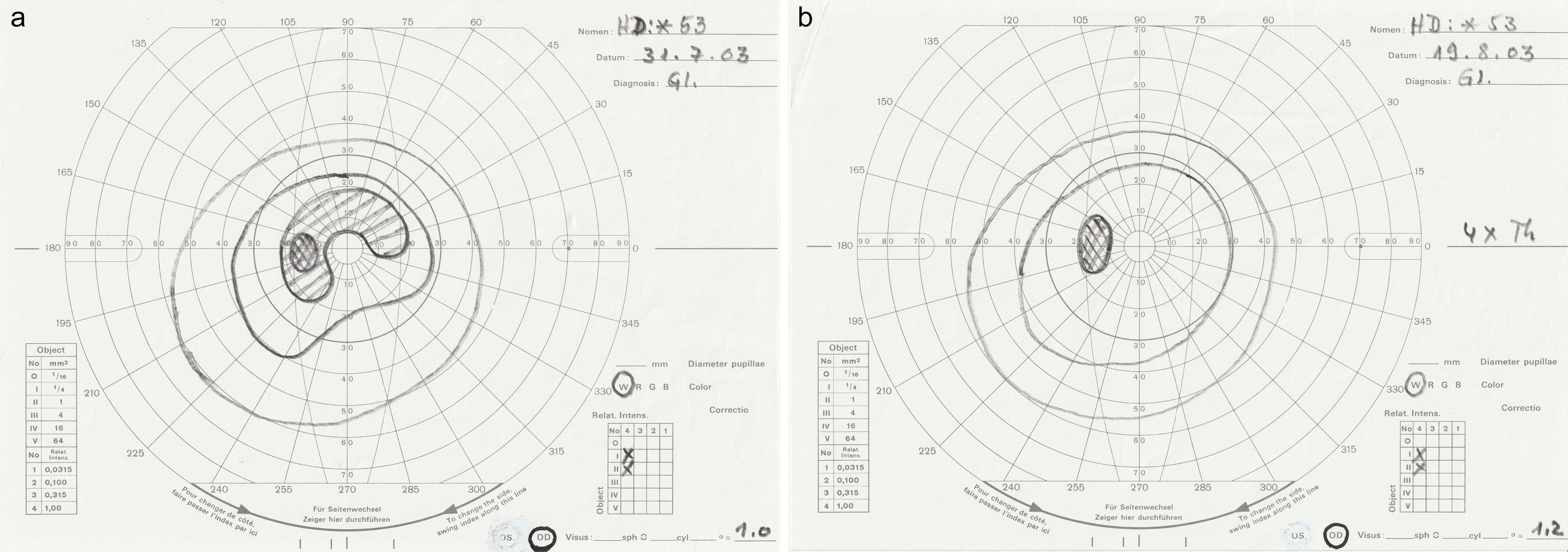 Kinetic perimetry of a Bjerrum scotoma, according to the method of Goldmann.