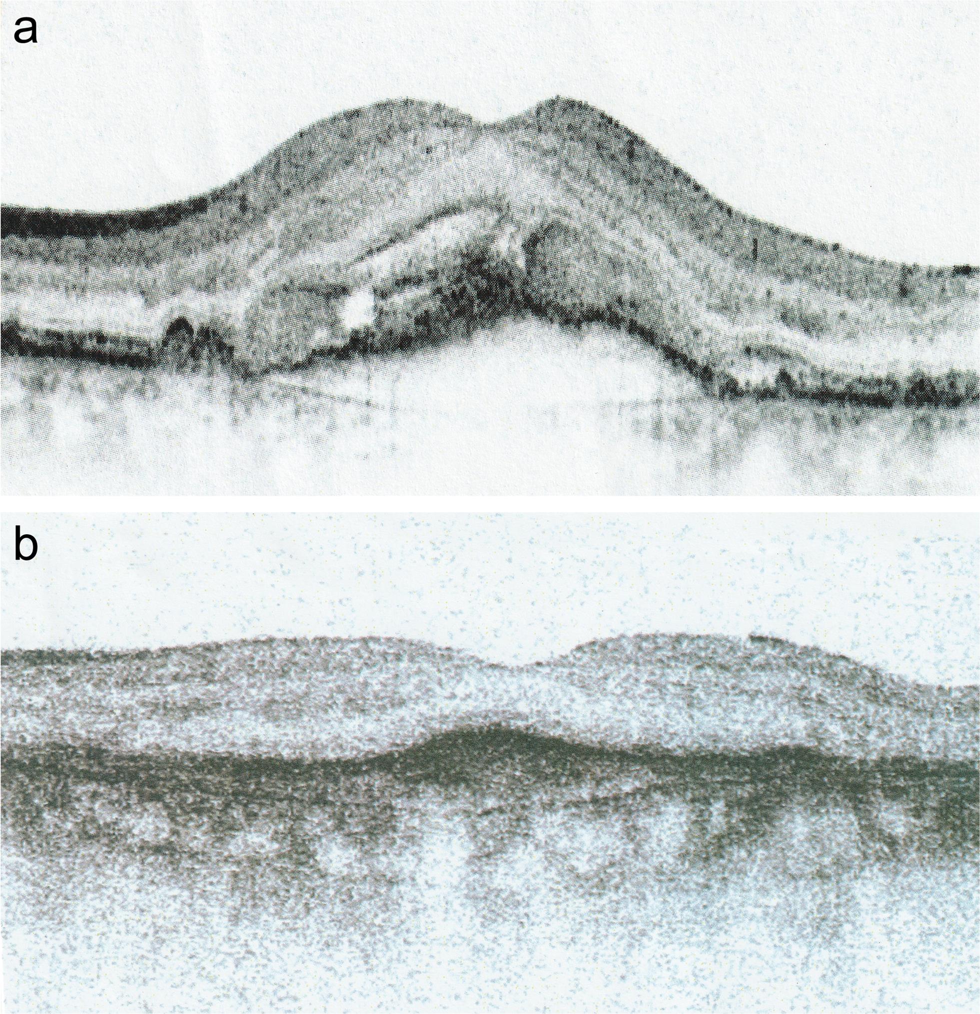 Exudative age-related macular degeneration.