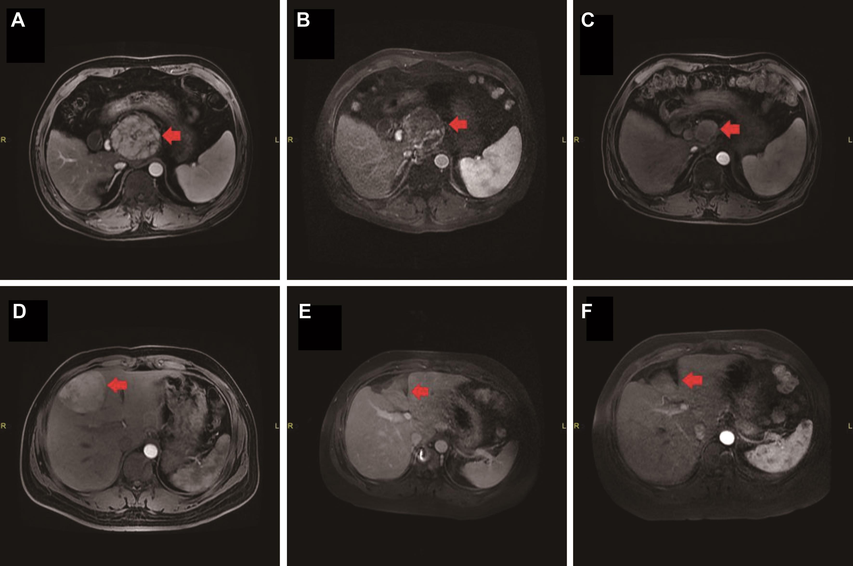 Magnetic resonance imaging (MRI) of patients with large HCC who were treated with CK-SBRT+TACE and HR.