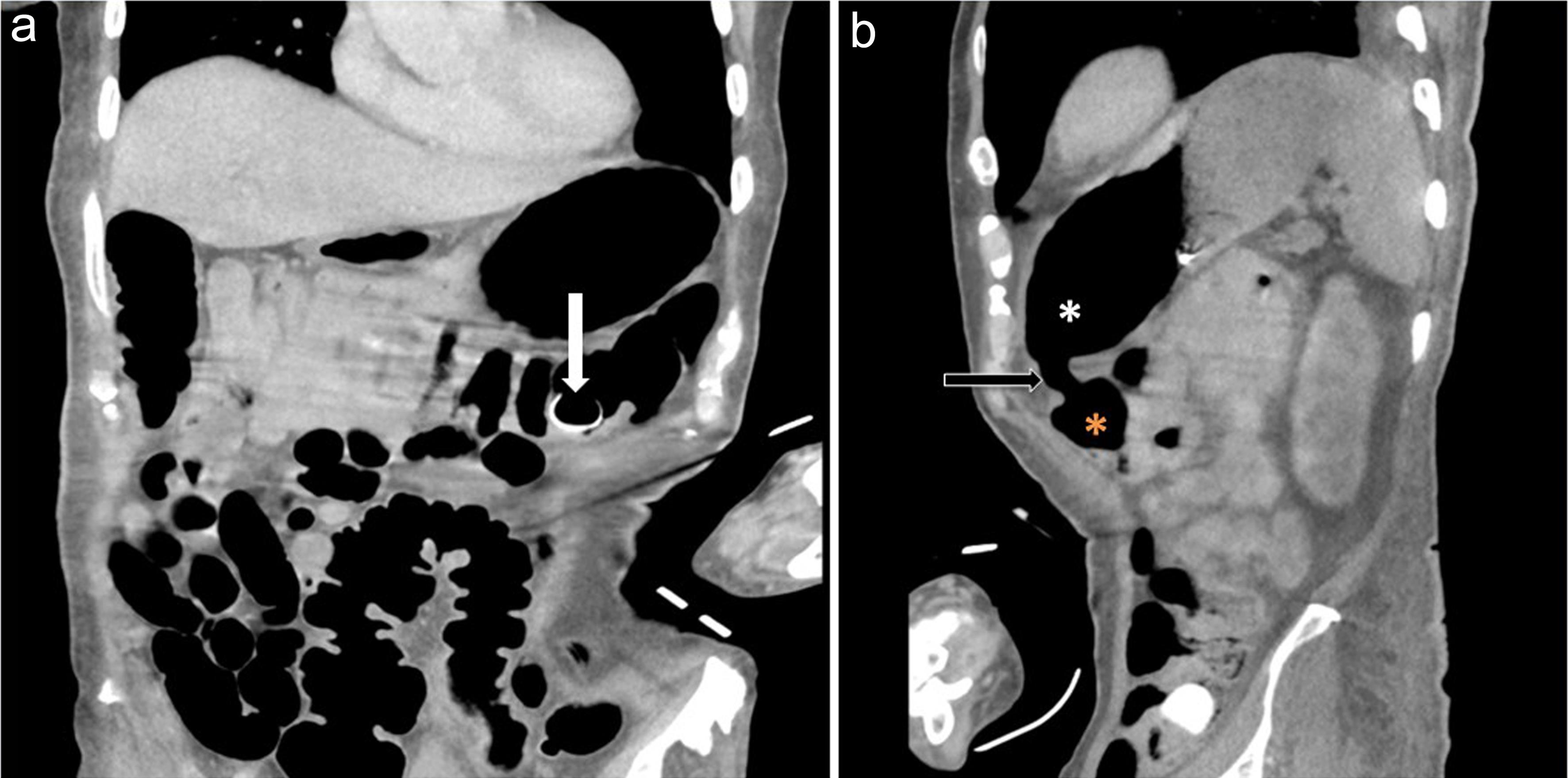 Coronal (a) and sagittal (b) contrast CT demonstrates the migrated balloon bumper in the distal transverse colon (a, white arrow) and a patent gastrocolic fistula (b, black arrow) between the stomach (white asterisk) and the colon (orange asterisk).