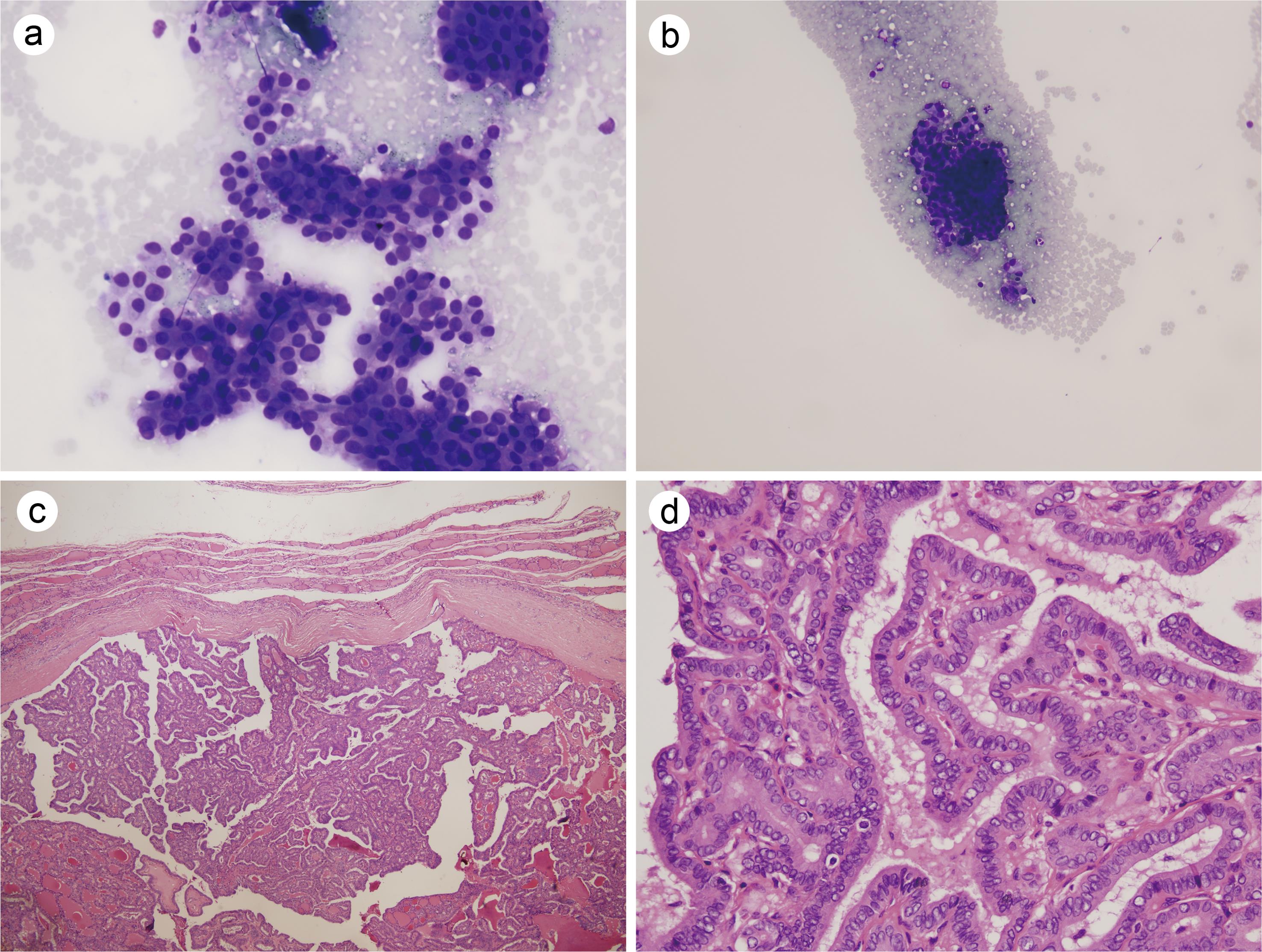 FNAC of a patient who was diagnosed with a suspicious malignancy via repeat cytology, underwent surgery, and was diagnosed with papillary thyroid carcinoma.