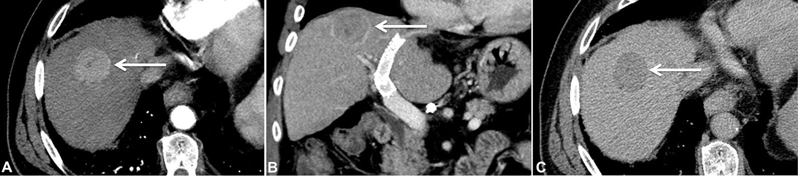 Multiphase, contrast-enhanced CT scan in a 52 year-old man with a history of cirrhosis and transjugular intrahepatic portosystemic shunt placement.