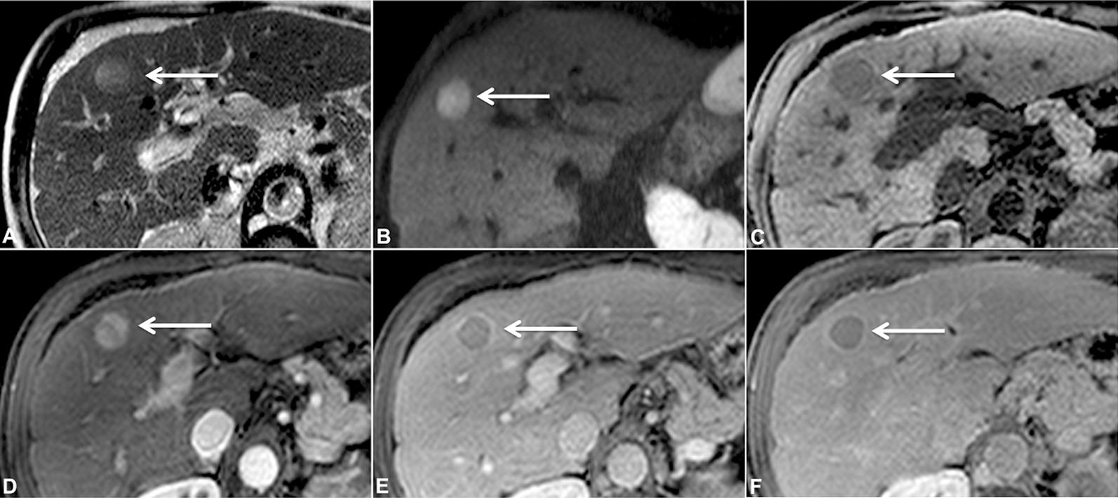 Multiphase, contrast-enhanced MRI in a 64 year-old man with cirrhosis.