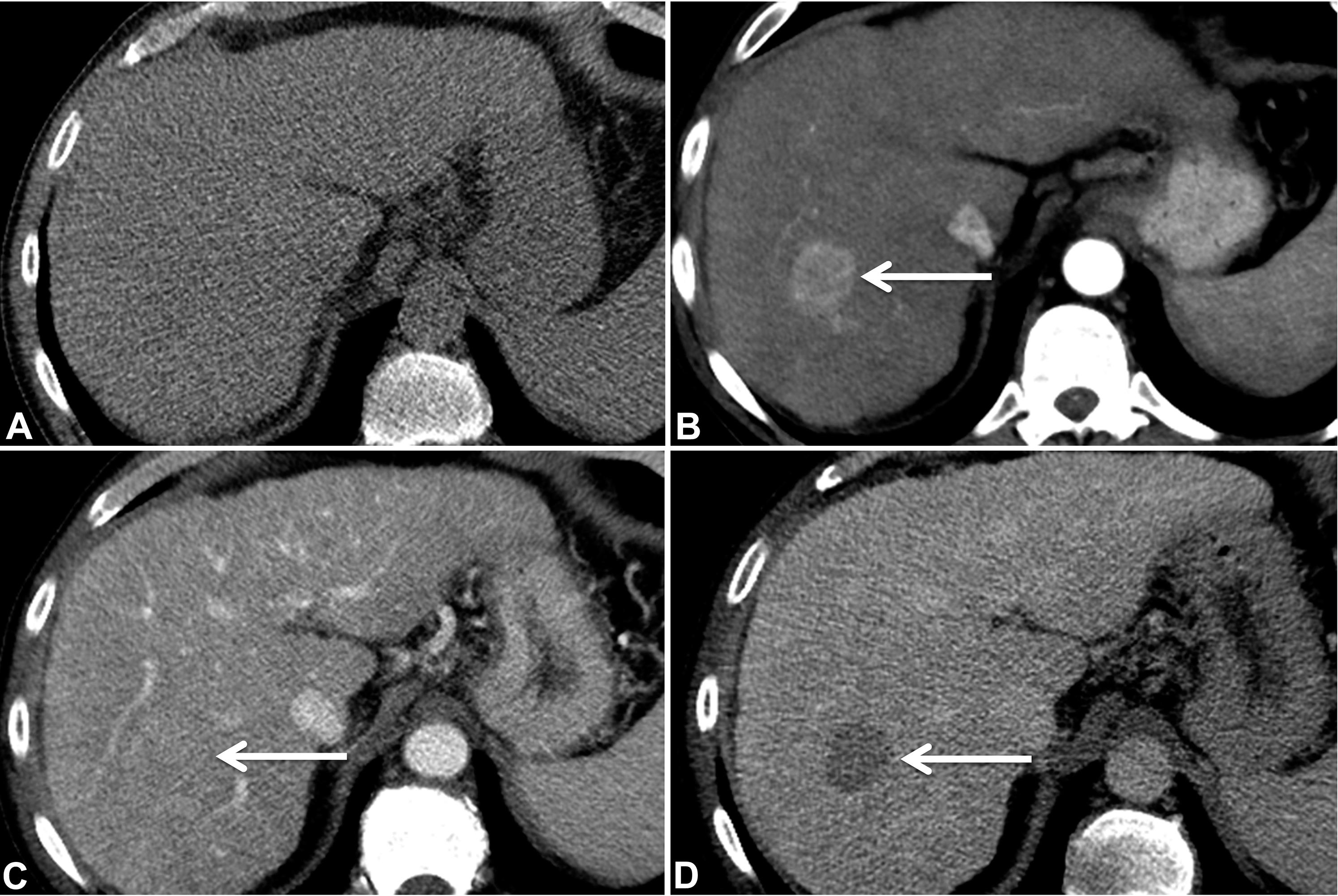 Multiphase contrast-enhanced CT in a 55 year-old woman with cirrhosis.