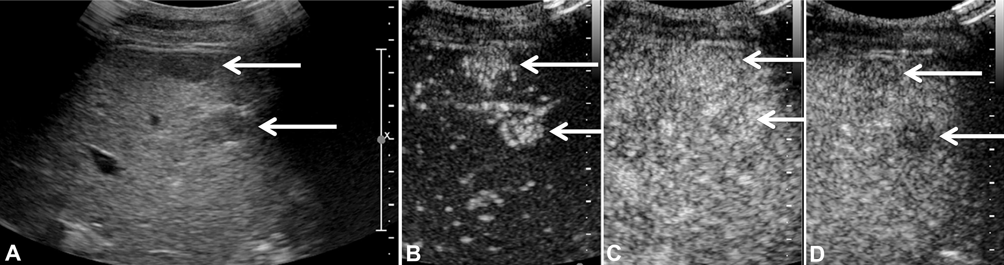 Contrast-enhanced ultrasound in a 48 year-old man with cirrhosis.