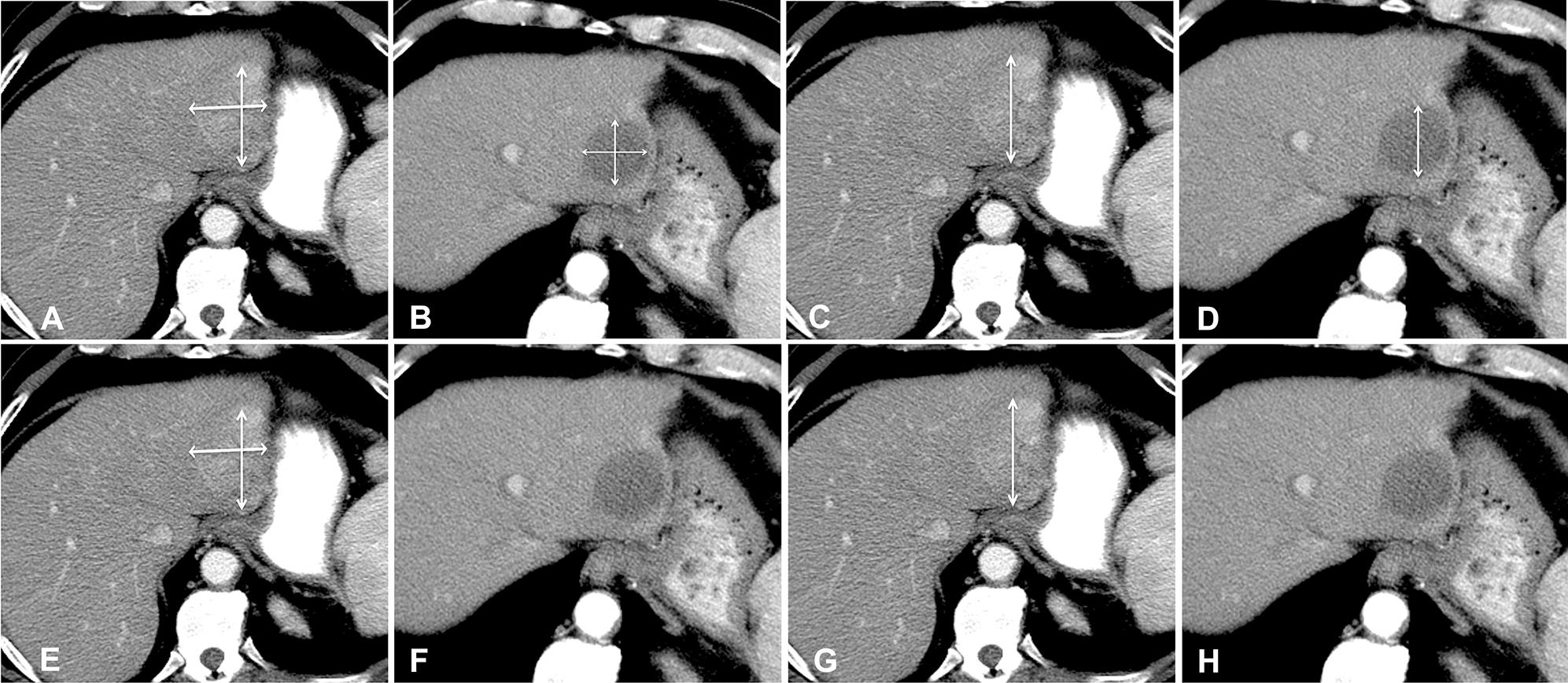 Multiple axial CT images in arterial phase in a 71 year-old man with HCC who was treated by DEB-TACE that demonstrate the most commonly employed radiologic response criteria.
