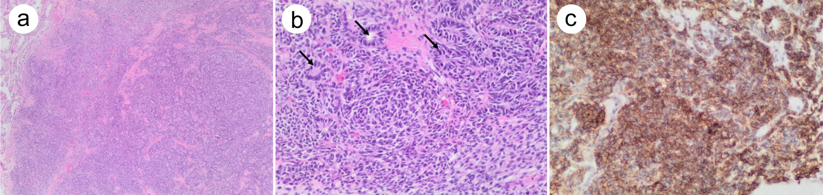 Embryonic-type neuroectodermal tumor arising from a testicular germ cell tumor.