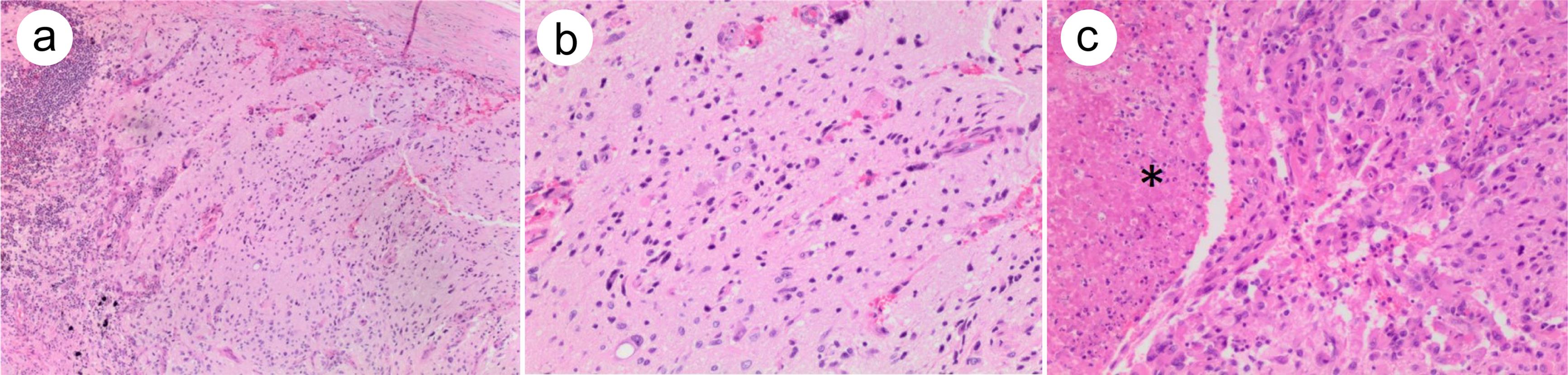 Ganglioglioma in a retroperitoneal metastasis from a germ cell tumor.