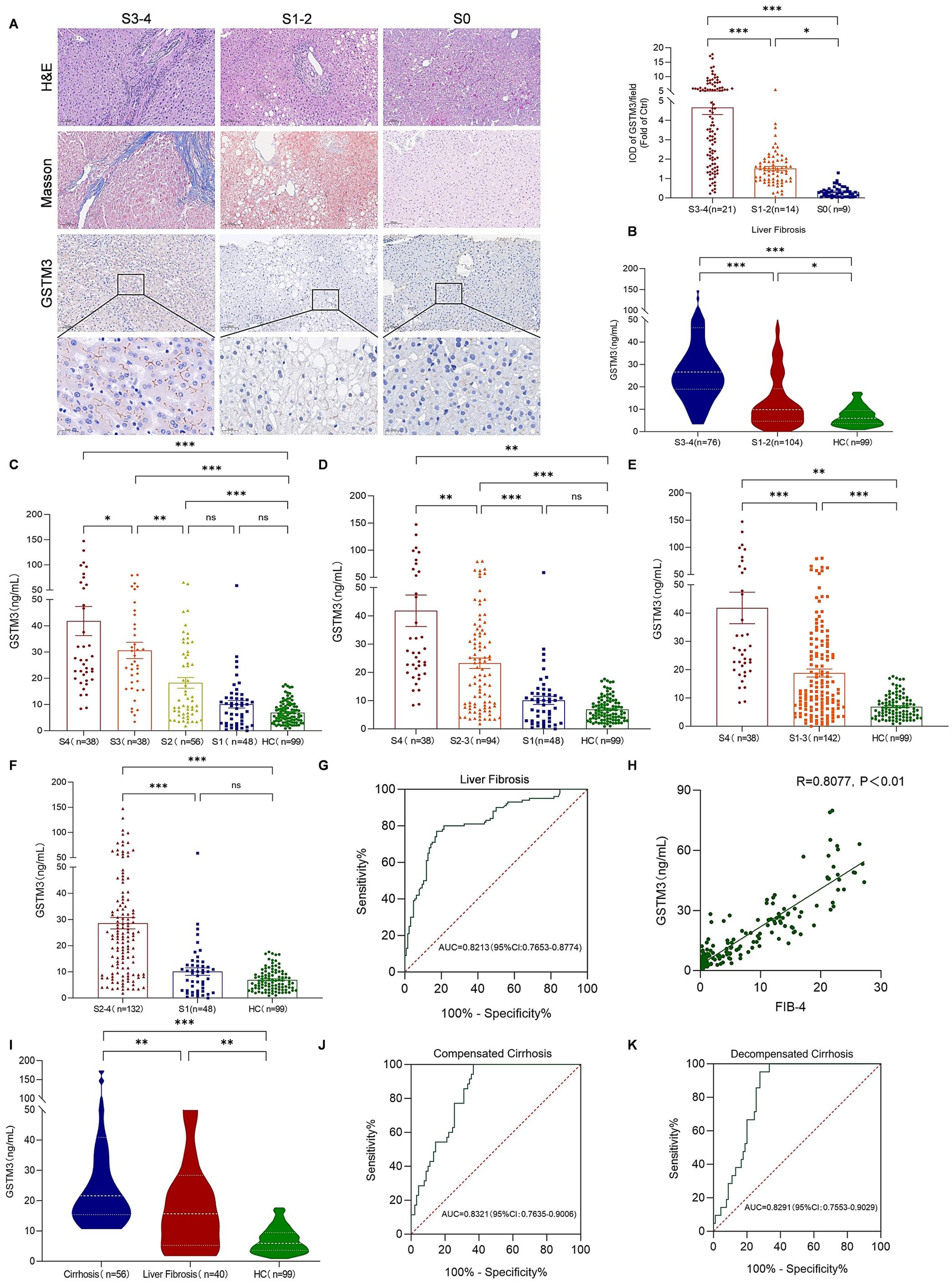 Analysis of GSTM3 levels in the serum and liver tissues of patients with fibrosis.