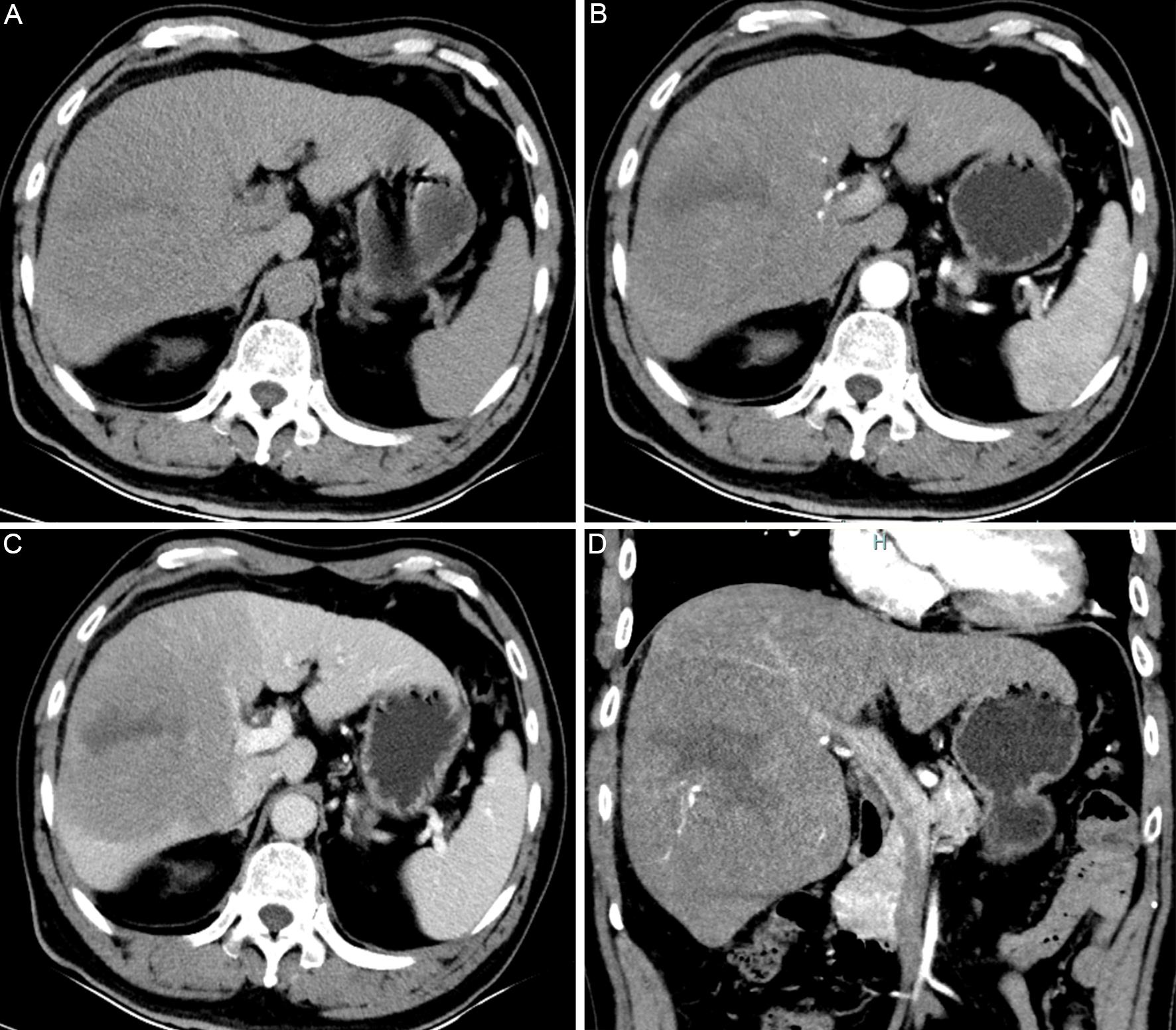 Abdominal contrast-enhanced computed tomography (CT) images obtained when the hepatic space-occupying lesion was detected.