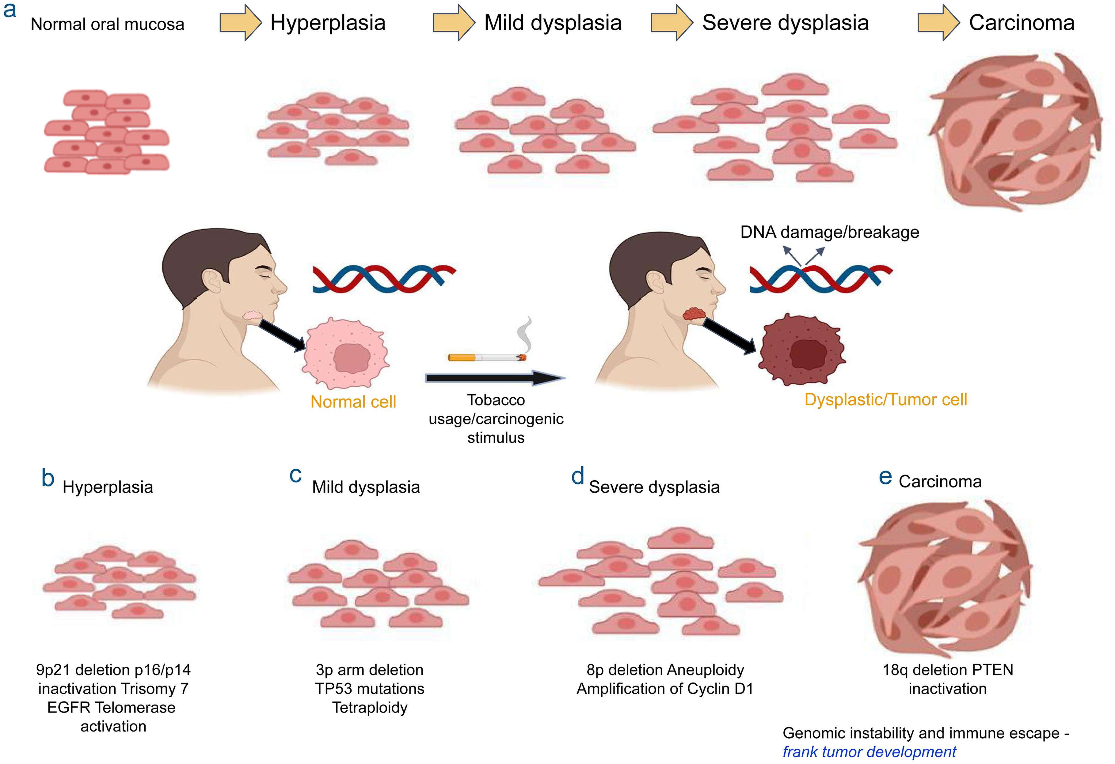 Oral cancer  progression and associated genomic alterations. (a) (top): Stepwise progression of oral squamous cell cancer, (below): Tobacco-induced carcinogens as a major factor behind dysplastic and cancerous transformation of oral epithelium; (b) Hyperplasia (9p21 deletion, p16/p14 inactivation etc.); (c) Mild dysplasia (3p arm deletion, TP53 mutation etc.), (d) Severe dysplasia (8p deletion, aneuploidy etc.); (e) Carcinoma (18q deletion, PTEN inactivation, genomic instability, immune escape etc.).