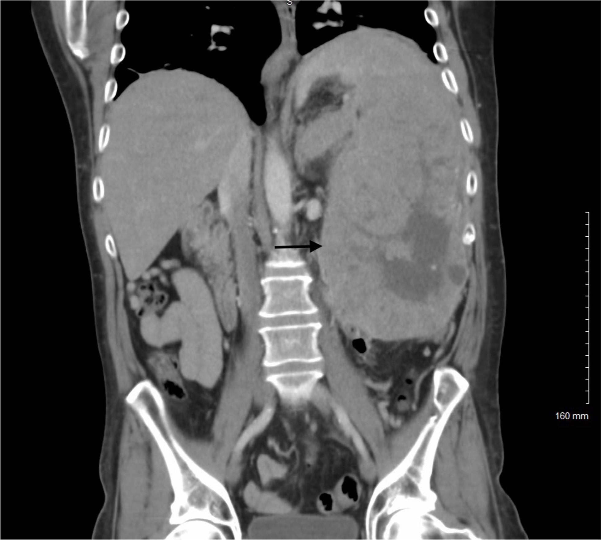 Computed tomography imaging shows a 22-centimeter, heterogeneous splenic mass with central necrosis.