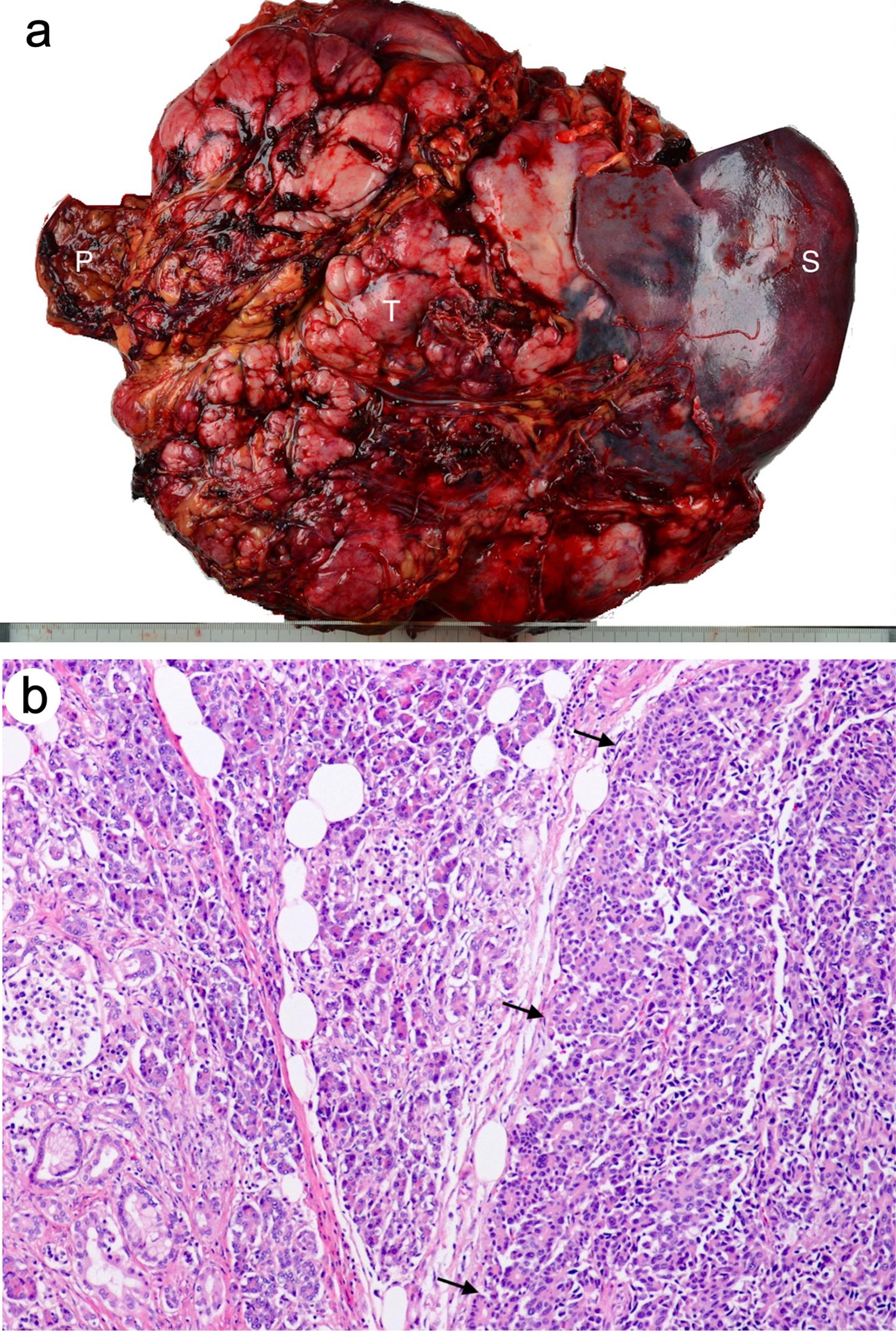 Resection specimen.