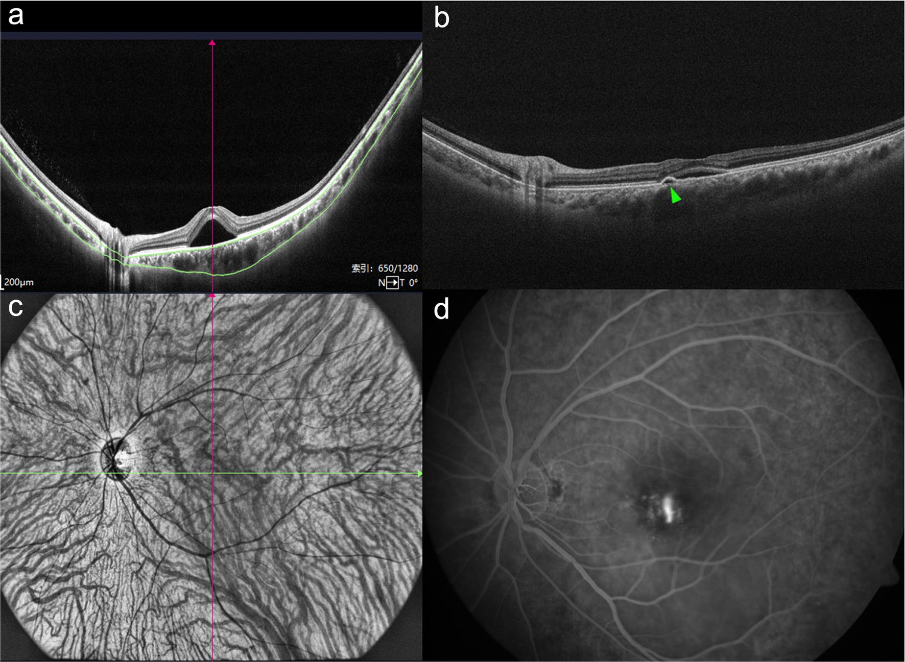 Multimodal fundus imaging of central serous chorioretinopathy.